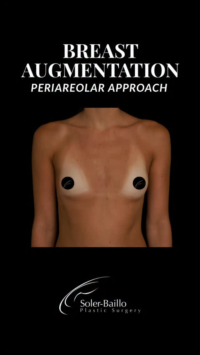 ❤️🔥 Small implants, beautiful impact.
This patient is just 3 weeks post-op after periareolar breast augmentation with 235cc implants. Even this early in recovery, her implants have already settled beautifully, creating soft, natural-looking fullness while maintaining balance and proportion. With the periareolar approach, the incision is discreetly placed along the natural border of the areola for a well-healed scar. ✨
Interested in learning more about breast augmentation? Schedule your consultation today.
📌 Soler-Baillo Plastic Surgery
📞 (305) 661-1996
💌 drsolerinfo@resultsmd.com
#PeriareolarBreastAugmentation #NaturalBreastAugmentation #UnderTheMuscleBreastAug #DualPlaneApproach #SolerBailloPlasticSurgery
