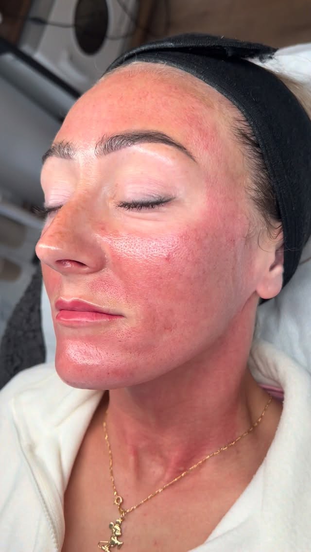Oshhhh spicy 🌶️ MEDICAL microneedling @xcellarispro_bydermaroller
Over 200% increase in collagen in ONE treatment!
Book Now for great Skin!
R x