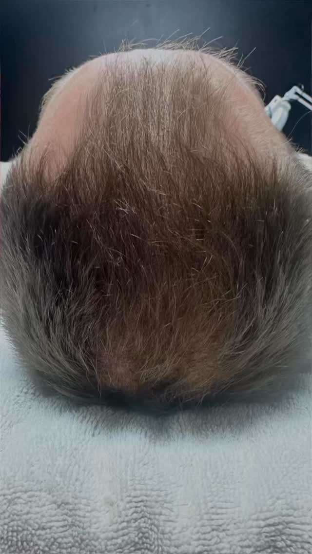 Hair growth treatment!
1 @procelltherapies hair treatment with 4 months of growth!
Dealing with hairloss book a Procell hairloss treatment!
#beforeandafter #hairgrowth #hairgrowthtreatment