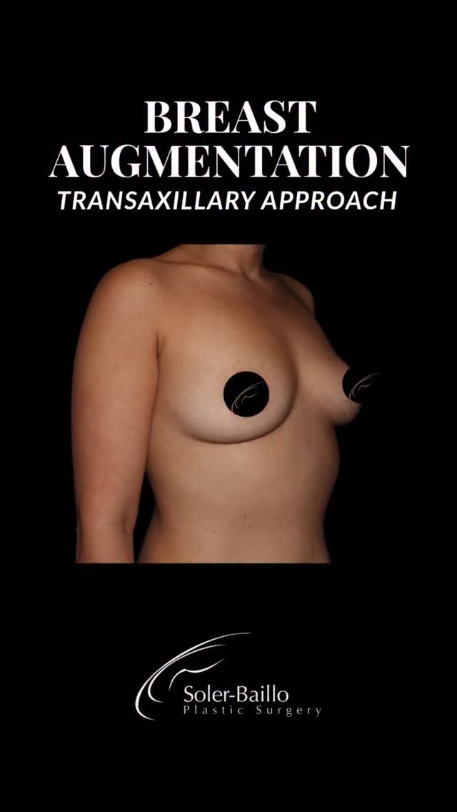All the way from Canada ✈️
Our beautiful patient traveled internationally for her transaxillary breast augmentation and just returned for her 7-month follow-up. Seeing her confidence and results continue to shine makes the journey worth it!
No breast scars. Natural-looking results. A personalized approach every step of the way.
Trust Dr. Soler-Baillo with your own transformation:
❣️ (305) 661-1996
❣️ Coral Gables, FL
❣️ drsolerinfo@resultsmd.com
#BreastAugmentation #TransaxillaryBreastAugmentation #BreastImplant #PatientJourney #BreastAugCoralGables