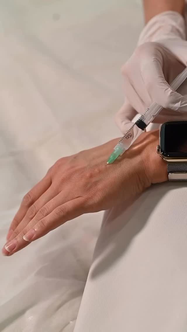 ✨ Hand Rejuvenation: PRF or Biorevitalization
Your hands are one of the first areas to show signs of aging. Over time, the skin becomes thinner, drier, and less elastic, making veins, tendons, and fine lines more visible.
For hand rejuvenation, we offer two effective options: PRF or Biorevitalization.
PRF helps stimulate natural skin regeneration using your own growth factors, improving skin quality, firmness, and texture.
Biorevitalization deeply hydrates the skin from within, improves elasticity, and gives the hands a fresher, smoother, more youthful appearance.
Both treatments help restore the beauty of your hands in a natural-looking way.
📅 Book your consultation and choose the option that is right for you.