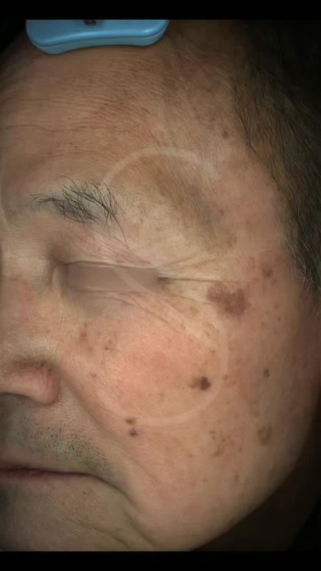From the top of his forehead to his chin/jaw- the pigment shadows, freckles, sun and age spots, we took care of all of it.
Transform your skin with PicoSure Pro! 😍
Targets 🎯:
✅ Post inflammatory hyperpigmentation
✅ Sun damage
✅ Freckles
✅ Acne scars
✅ Fine lines (stimulating collagen)
✅ Pores (minimizing pro size)
✅ Skin complexion (evening out tone and yellowing)
✅ Texture
Safe for all skin types and tones! We’ve worked with all Fitzpatricks and specialize in PicoSure Pro.
Book with our link in bio 🔗 for a comprehensive consultation on hyperpigmentation removal.
#northyorkskinclinic #picosurepro #torontoskinclinic #hyperpigmentation #acnescarsremoval