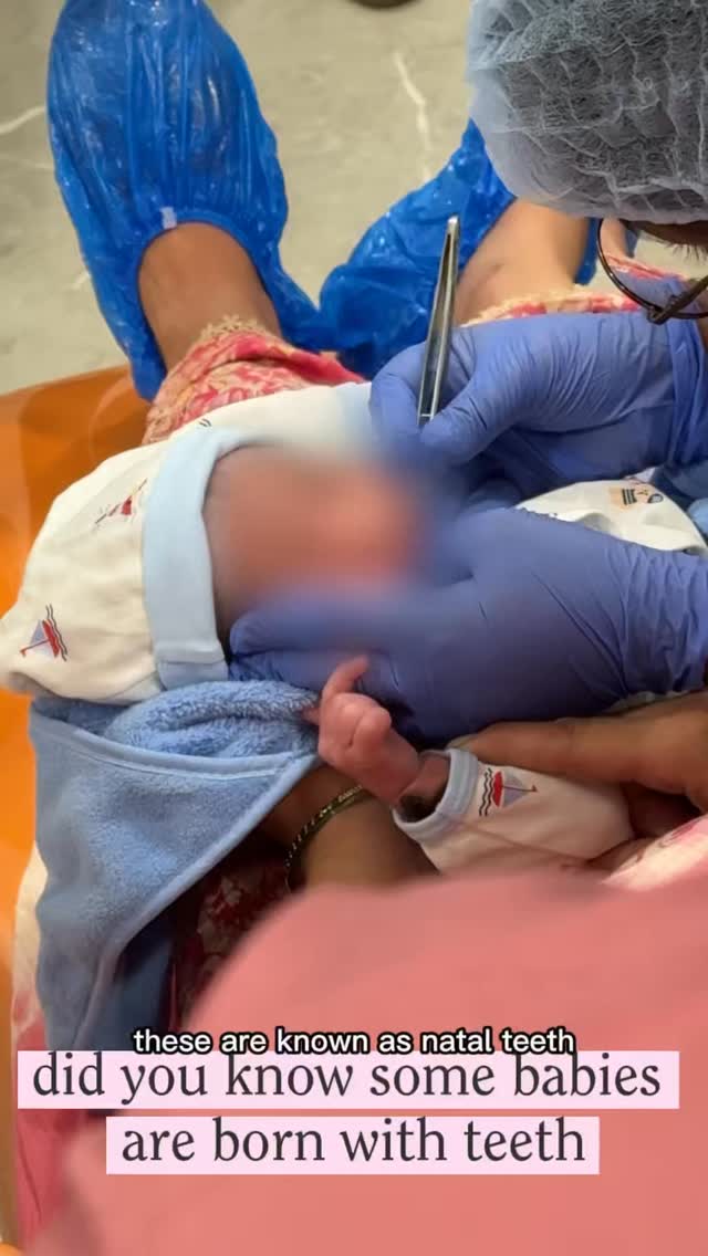 A little milestone handled with extra care! ✨ Natal teeth (teeth present at birth) are rare, but when they cause discomfort or feeding challenges, safe and gentle removal is essential. Our team successfully removed natal teeth for a sweet little one to ensure smooth feeding and total comfort. Gentle care for the precious new smiles! 🍼🤍
#PriveAesthetics #NatalTeeth #PediatricDentalCare #NewbornCare