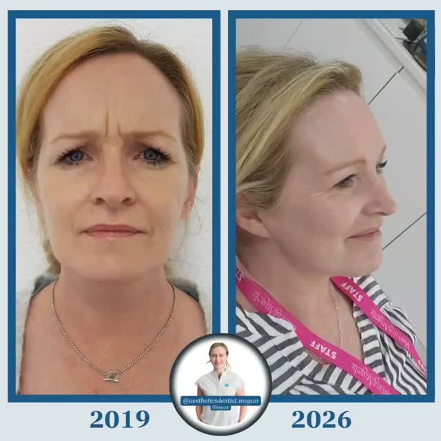 This is what you can achieve when you find the right practitioner for you and commit to the marriage, not the one night stand treatment.
Meet Angela. One of my first ever patients back in 2019 who has been on a maintenance programme with me ever since.
Look at the difference!
Skin quality
Skin texture
Mouth corners
Eyebrow position
Just.. everything!
We've focused on a mixture of treatments to address several layers of Angela's anatomy, but she LOVES a skinpen microneedling treatment coupled with a skinbooster. (In this case profhilo)
I think it also helps that she's a gorgeous human being inside and out which most definitely adds to her Glow.
Megan x