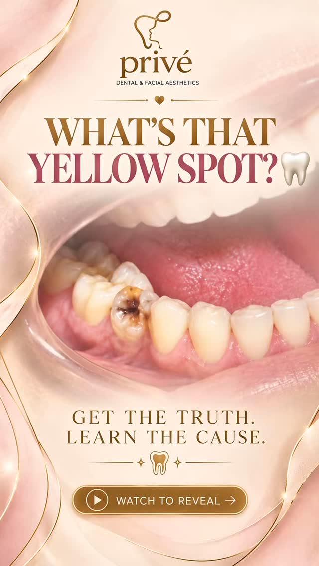 Deep down, when tooth decay reaches the nerve, it’s time to stop the pain and save your natural smile. But what actually happens during a root canal?
We’re breaking down the process step-by-step to show you why it’s not something to fear—it’s relief in disguise!
Step 1: Gentle numbing to keep you completely comfortable.
Step 2: Removing the infected pulp and cleaning the canals.
Step 3: Sealing and restoring the tooth back to full strength.
Say goodbye to the ache and hello to pain-free confidence! 💫
💬 Have questions about root canals? Drop them in the comments below!
#rootcanal #DentalEducation #PrivéDental #toothpain