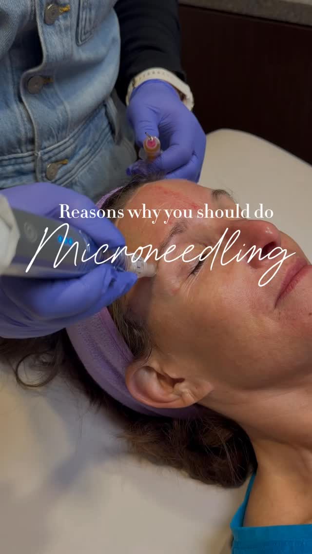 Your makeup shouldn’t have to do all the heavy lifting. ✨
Uneven texture, acne scars, and fine lines? Microneedling helps stimulate collagen production to improve their appearance—giving your skin a smoother, more refreshed look over time. 💜
At Radiance, we tailor your treatment plan to your skin and your goals. Because great skin starts with the right approach.
Ready to give your skin some attention? Book through the link in our bio.
📍 Radiance Medspa | Fairfax, VA
📞 703-222-0173
#Microneedling #FairfaxMedspa #AcneScarTreatment #SkinRejuvenation #NorthernVirginia
