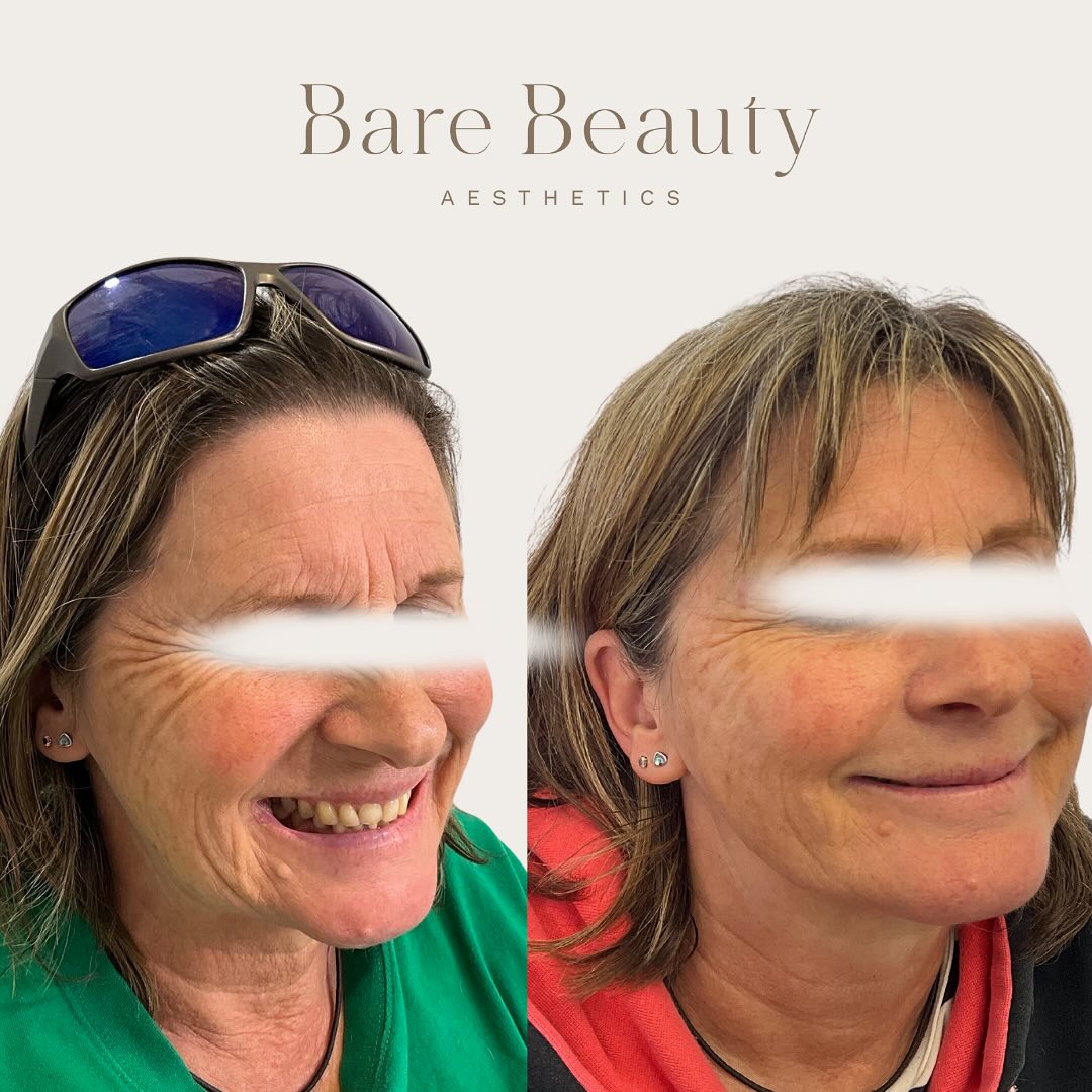 Providing receipts that prove…. skin quality DOES MATTER!!!
This beautiful client received a treatment that’s specifically designed to help improve her “skin quality” by boosting hydration and improving elasticity for a fresh, youthful glow.
Please Note: “After” photo was taken 4 weeks post initial treatment 🤯💖 photos have been shared with clients consent.
Seriously amazing result’s. Skin is glowing, fine lines reduced and skin quality is goooorgeous❤️
Ready to elevate your beauty? If you’re interested in learning more, please send me a DM or alternatively you can book a complimentary consultation with me (link in bio) where we will work together and create an individualised treatment plan 💕
.
.
.
.
.
.
#cosmetics #cosmetinjectable #cosmeticnurse #aesthetics #aestheticnurse #antiaging #beauty #filler #injections #dermalfillers #neuromodulators #skincare #wrinkles #finelines #antiwrinkle #facialesthetics #ilovetaupo #womenempowerment #selfcare #booknow #consultation #linkinbio
📍Located Taupo