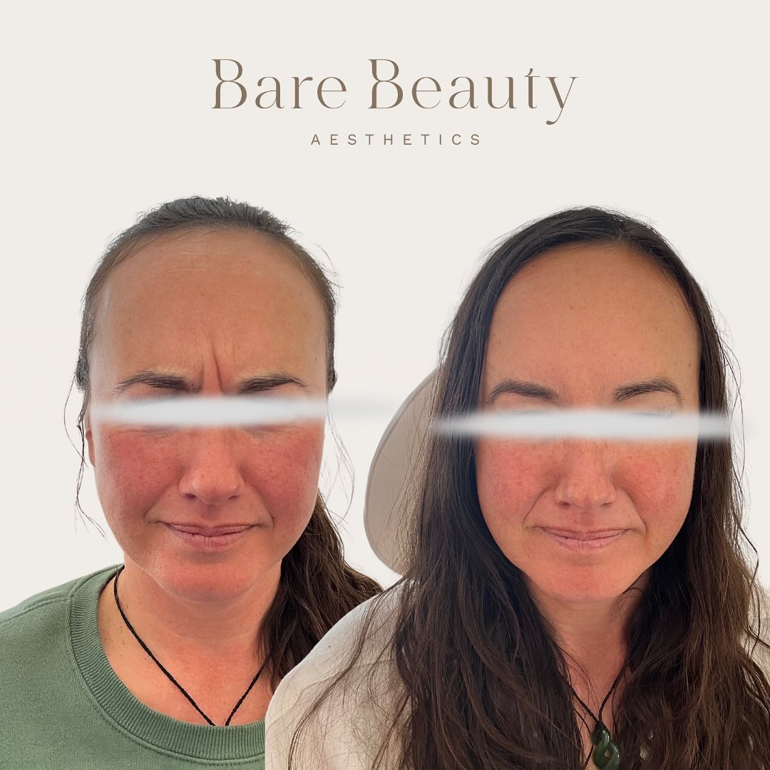Goodbye frown lines! 👋
Check out these amazing results just 2 weeks post-treatment 🤯 AND YES! SHE IS DEFINITELY FROWNING IN BOTH PHOTOS 😂😂😂
Photos have been shared with clients consent.
This beautiful client is absolutely obsessed with her first anti-wrinkle experience! I can’t thank you guys enough for trusting me with your faces 🥹 it’s truly an honour and something I don’t take for granted.
If you’re interested in learning more about Cosmetic Injectables and how they can potentially help you, please send me a DM or alternatively you can book a complimentary consultation with me (link in bio) where we will work together and create an individualised treatment plan 💕
📍Located Taupo
#cosmetics #cosmetinjectable #cosmeticnurse #aesthetics #aestheticnurse #antiaging #beauty #filler #injections #dermalfillers #neuromodulators #skincare #wrinkles #finelines #antiwrinkle #facialesthetics #ilovetaupo #womenempowerment #selfcare #booknow #consultation #linkinbio