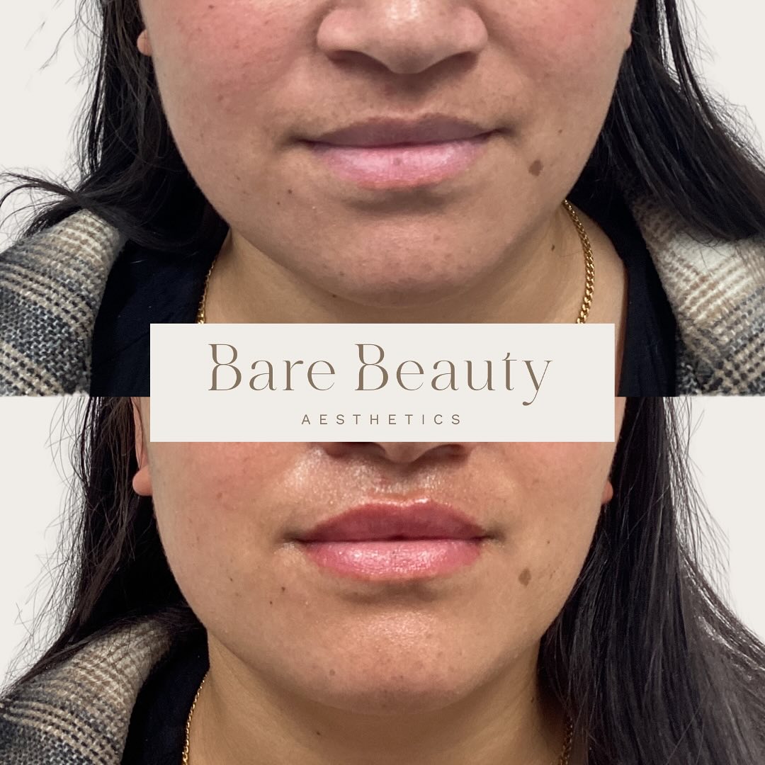 Sprinkle of hydration and plumpness 👄💉✨
Lovely client was really feeling it this past winter with dehydrated lips. So wanting to add a bit of filler to help with keeping her lips hydrated while also adding a sprinkle of overall plumpness 😌
If you’ve been thinking about getting any injectable treatments, please feel free to book in a complimentary consultation (booking link in bio) or you’re more than welcome to flick me a private message where I will get back to you as soon as possible 😊
After photo taken directly post treatment. Photos shared with clients consent💖
Dermal Filler, Medical Device Class III to smooth facial wrinkles and folds, correct facial atrophic scars, restore or enhance the lips, or restore facial volume. Dermal filler has risk and benefits. Ask your doctor if dermal filler is right for you. For product information, check with your doctor or from product details with the supplier.
#cosmetics #cosmetinjectable #cosmeticnurse #aesthetics #aestheticnurse #antiaging #beauty #filler #injections #dermalfillers #neuromodulators #skincare #wrinkles #finelines #antiwrinkle #facialesthetics #ilovetaupo #womenempowerment #selfcare #booknow #consultation #linkinbio #lipfiller