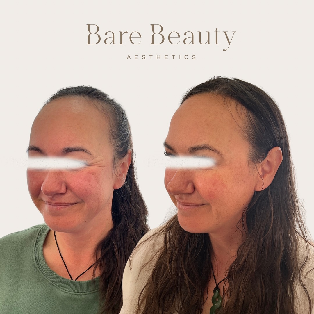 Softening the lines around your eyes/ crows feet is truly a game changer! 💉✨
Many clients notice that easing the lines around their eyes helps them appear more refreshed. It not only minimizes the look of tiredness but also can help lift the brow, adding a touch of femininity and vibrancy.
Curious to know more? Contact Hayley at Bare Beauty Aesthetics or schedule your complimentary consultation via the link in our bio!
📍Located: Taupo, New Zealand
.
.
.
.
.
.
.
.
.
#CosmeticInjectables #Botox #DermalFillers #BeautyEnhancement #SelfCare #ConfidenceBoost #BodyPositivity #LoveYourself #NaturalBeauty #GlowUp #AestheticGoals #FeelGoodLookGood #YouthfulSkin #BeautyInEverySize #EmpoweredBeauty #BeautyForAll #RadiantConfidence #SkincareGoals #SelfLoveJourney #beautycommunity