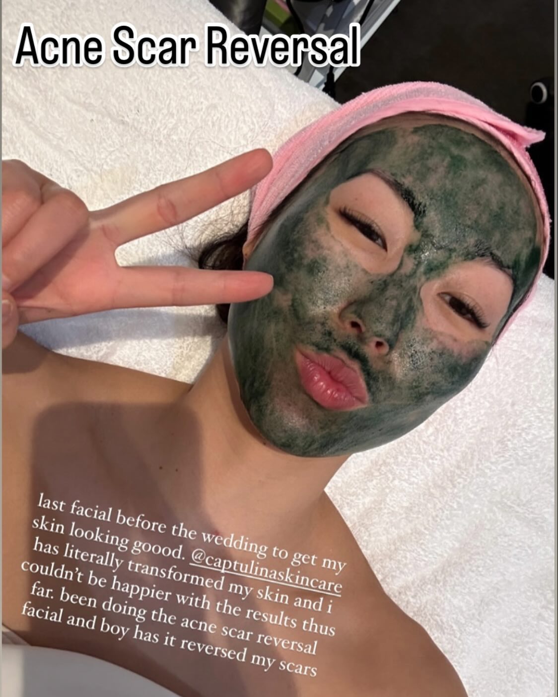 Getting @allie.eats skin ready for her wedding has been exciting and an honor! Smoothing out the uneven skin texture and making her skin younger healthier, and brighter is not only rewarding for me, but also keeps me so motivated to help others that have issues with their skin. If you would like to learn more about this treatment and with the journey might look like for you, feel free to reach out to me. We can create a plan for the new year coming up. I look forward to hearing from you.🩷 #acnescars #acnescarsremoval #koreanskincare this treatment also helps with #melasma #hyperpigmentation