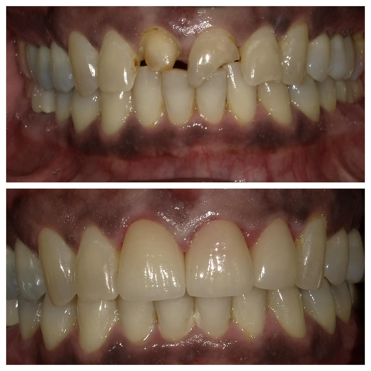 My patient, who is in his late 50s, had a bike accident that left him with two broken front teeth and trauma to the lateral teeth, which required root canals. To achieve optimal aesthetics, I recommended crowns for the upper four front teeth. The second picture shows the crowns during the try-in stage, not yet fully cemented. After cementation and some healing time for the gums, the final results were even better—and the patient couldn’t have been happier with his new smile! 💫 #CosmeticDentistry #SmileTransformation#dccosmeticdentist#shawlogandentist#shawdentist#dcdentist#dccosmeticdentist