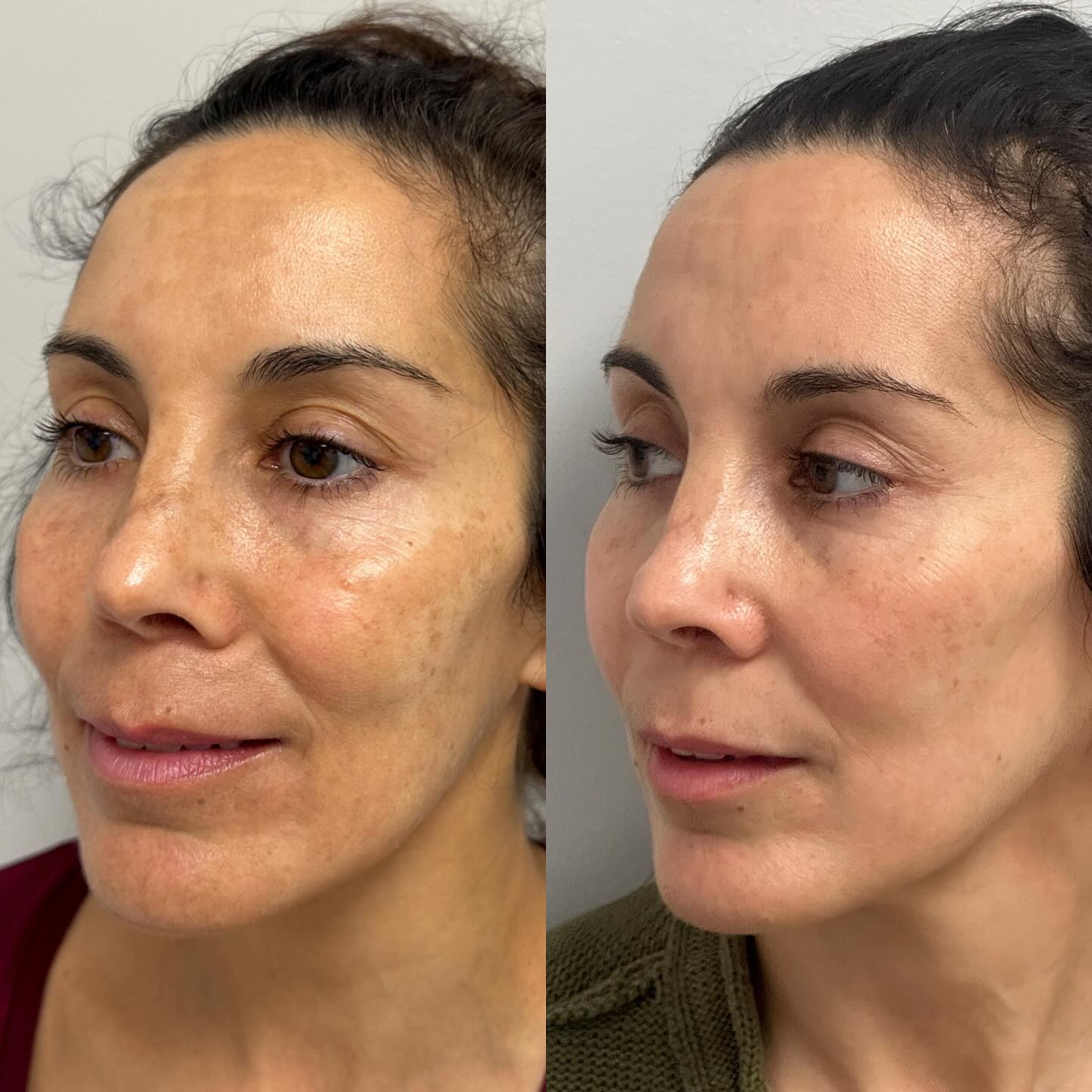 Small but mighty…I know you might think we’re talking about all 5’3 inches of me (and this would be accurate) but HELLOOO we’re talking about Clear & Brilliant laser.
This laser came out new and improved and is now a pigment fighting powerhouse. This result was based on just TWO treatments and the addition of only 2 skincare products with a focus on evening skin tone and brightening the skin overall.
#skin #meslasma #darkspots #koreanskincare #skintips #clearskin #glassskin