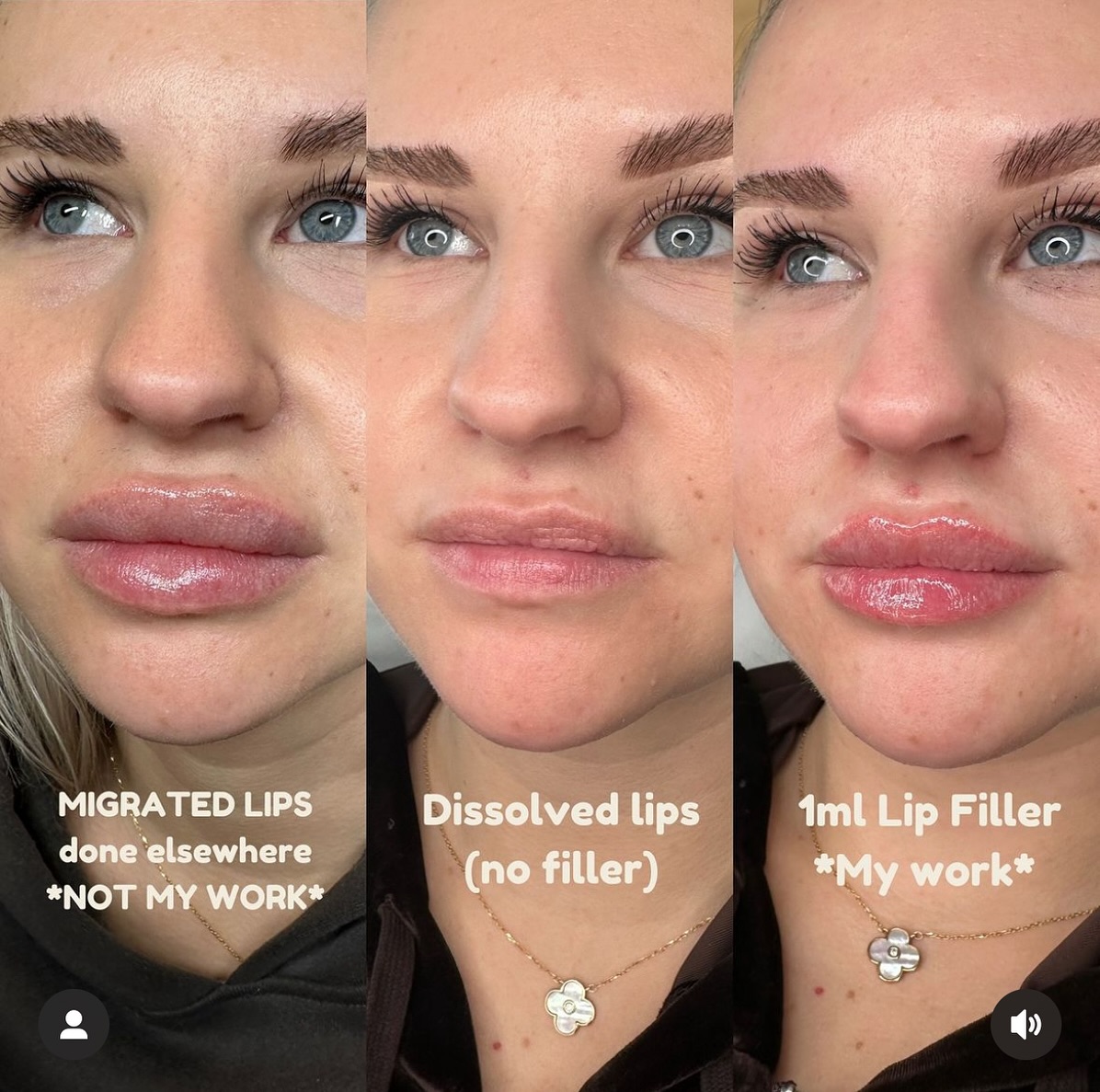 Here is an example of the dissolving and refilling process ✨✨✨✨✨✨✨
This gorgeous client was injected elsewhere and came in with concerns of overfilling, shape loss and migrating.
We were so excited to help her and were very happy with the results 🖤
What do you think?
✨ Free consultations available ✨
#lipfiller #dissolve #lipfillervaughan #injectables #injectablestoronto #aerolase #skincare #beauty #microbladingvaughan #microblading #lashesvaughan
