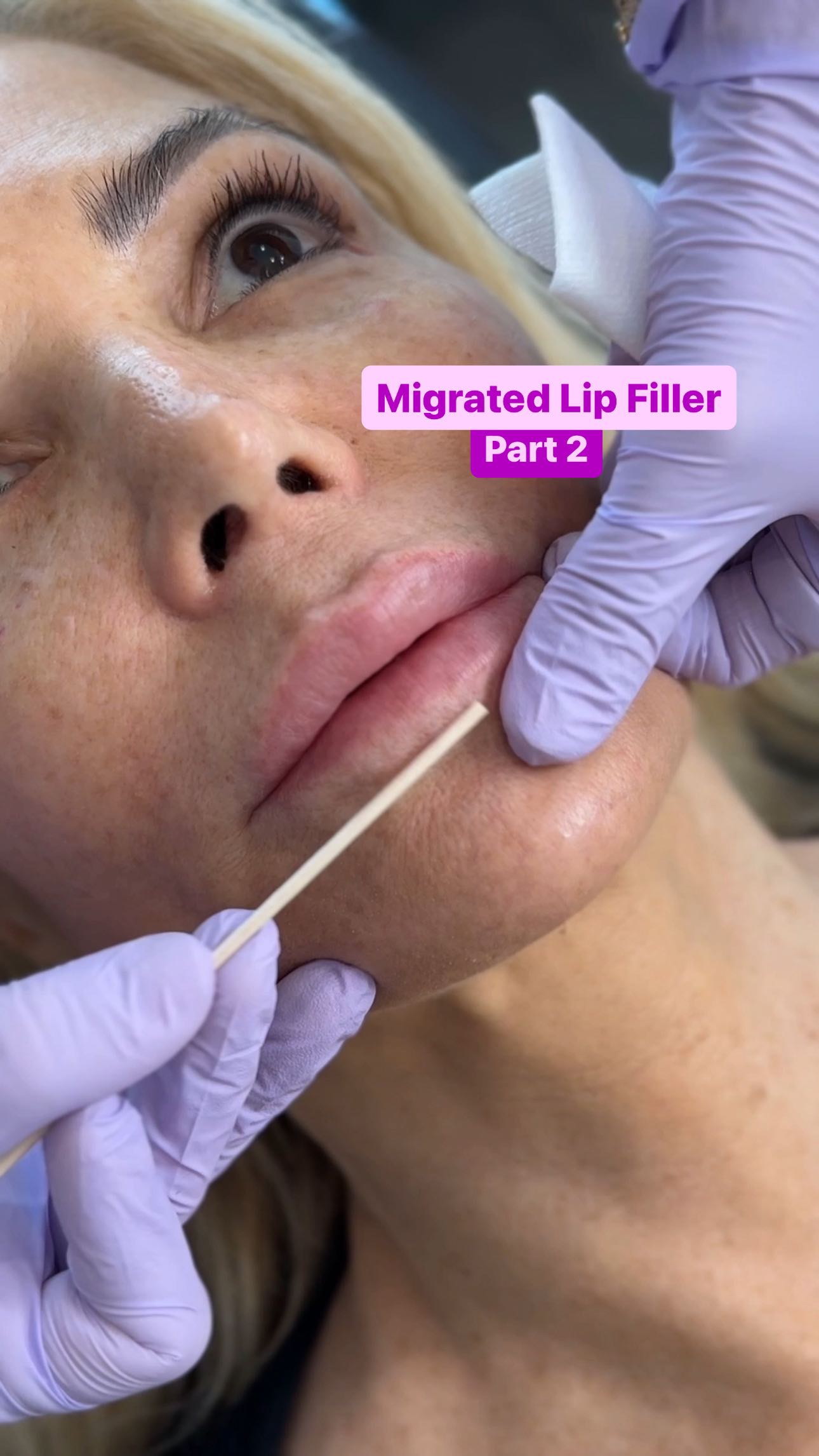 In Part 1, we dissolved some of the migrated filler under lip border. Now, we’re going to add a little filler to her lips to add volume. We may dissolve a little more of the migrated filler in the future. Stay tuned!
.
.
#lipgloss #lips #lipfiller #pout #dissolvefiller #fillerdissolving