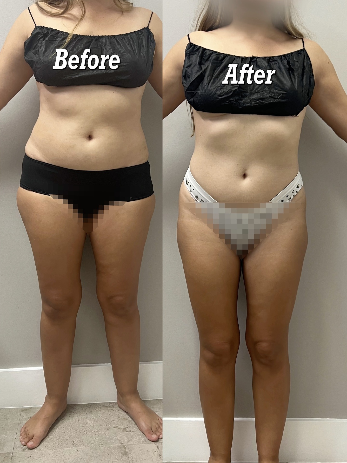 Discipline + Body Treatments = Results
This body transformation is proof that a:
-A balanced diet
-Regular physical activity
-And body treatments
Can go a long way and create lasting results.
You can DM me if you have any questions
Disciplina + Body Treatments = Resultados
Esta transformación corporal es testimonio que:
-Una dieta balanceada
-Actividad física frecuente
-Y tratamientos corporales
Pueden proveer resultados asombrosos
Me puedes escribir al DM si tienes alguna pregunta
#bodytreatment #woodtherapy #medspa #bodytransformation #ınstagood #ɪɴsᴛᴀʀᴇᴇʟs #love #selfcare #newme #beauty #mybodymytemple