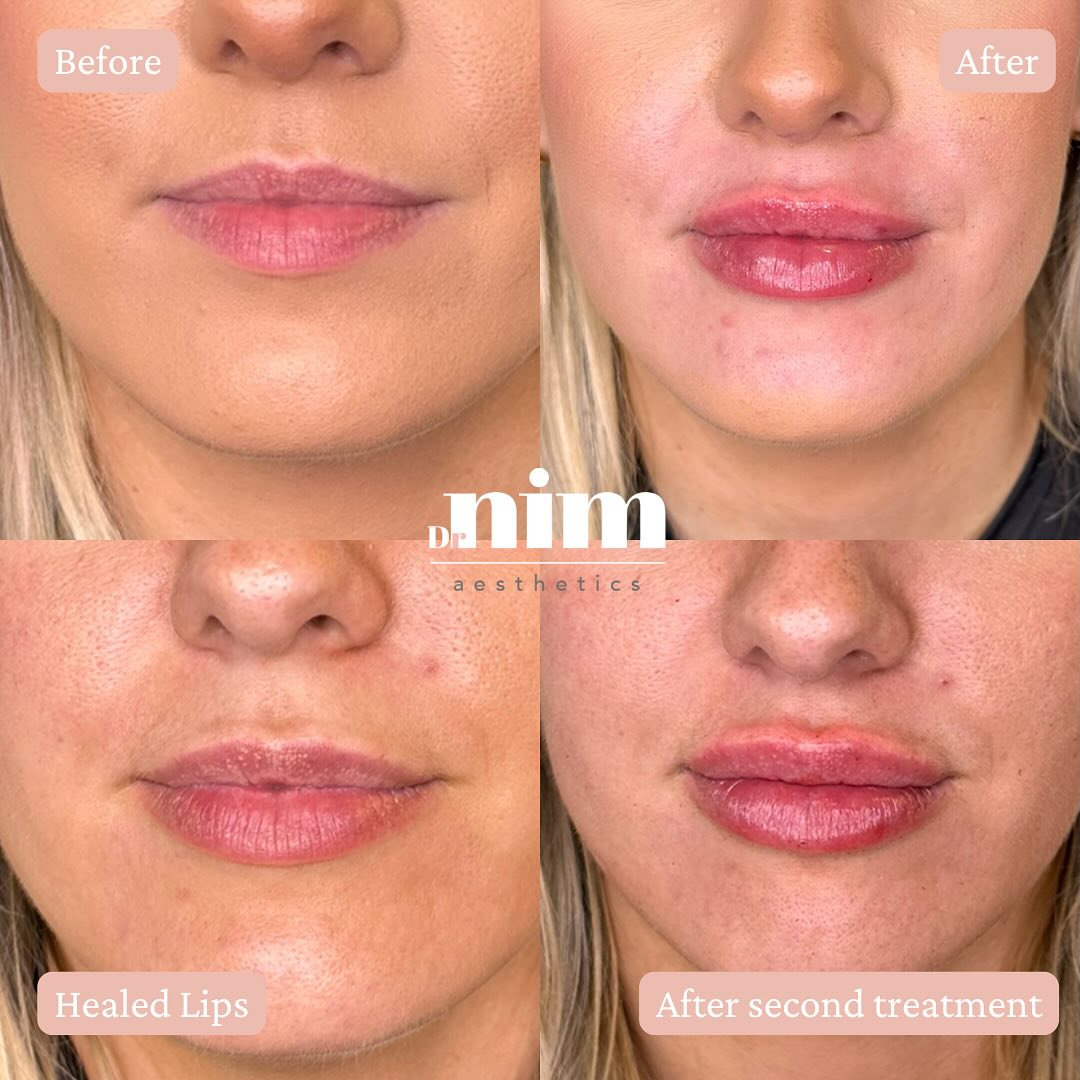 Slowly…building….volume 👄
This gorgeous patient wanted to enhance her lips, but she had some concerns about adding volume too quickly. We took it slowly, and built up her lips over two sessions.
This gradual approach allows for beautiful, natural results while finding the perfect balance!
These photos are taken after her first and second treatments, showing how we can subtly (and safely!) add volume.
Curious about lip filler but not sure where to start? Drop me a message to book your initial consultation 📩
#naturalresults #naturallips #subtlelips #subtleresults