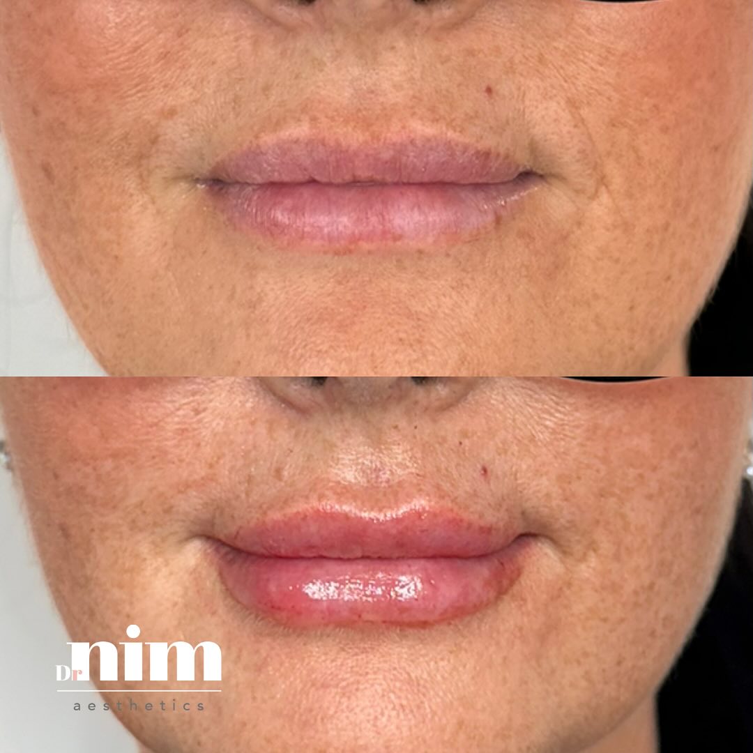 Another natural, subtle and beautiful result 💋
Lip filler treatments don't always result in big, huge, pouty lips. Even a subtle enhancement can give lips a more youthful look.
Curious about lip filler but not sure where to start? Drop me a message to book your initial consultation 📩
#naturalresults #naturallips #subtlelips #subtleresults