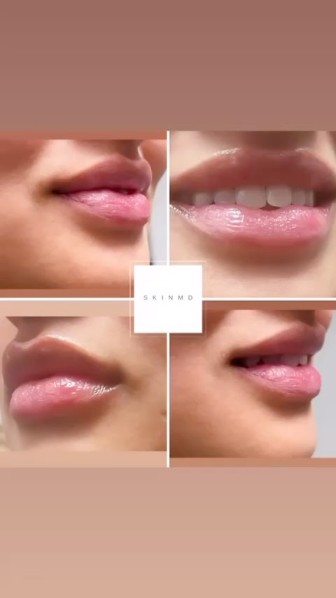 ✨ After treatment glow! Subtle, natural plump lips with perfect volume. 💋 Our Black Friday special is the perfect time to enhance your smile. Book now for 50% OFF! 💉 Offer ends Nov 30. Call 905-847-7017 or DM us today! #NaturalBeauty #LipFiller #SKINMD
