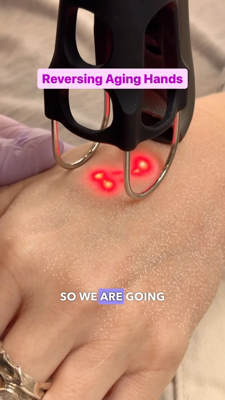 👋💥Resurfacing Treatment for Aging Hands
Today we’re using our CoolPeel laser to resurface, improve texture and discoloration. The thin skin on the hands can experience changes in tensile strength, pigmentation, and volume over time.
#co2laser #finelines #handcare #skin #skincare #facial