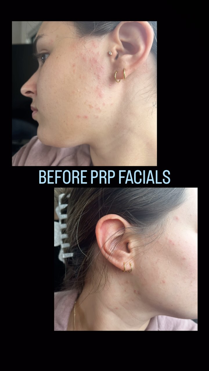 From red and inflamed to radiant and clear β¨ PRP facials truly transform skin! Proof that glowing skin starts with the right care π #SkinJourney #PRPFacial #GlowUp #Dermalign