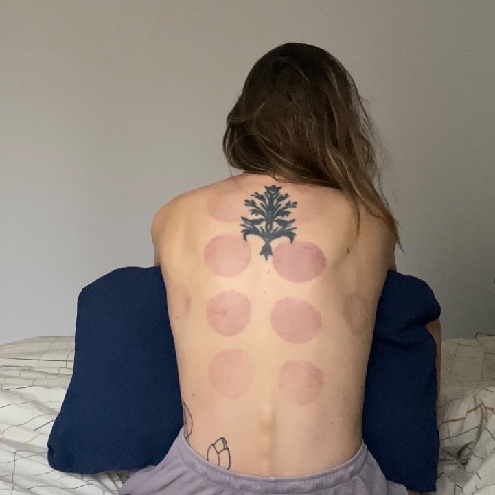 Vakuuminės taurės neskausmingas metodas gerinti kraujotaką, mažinti nugaros, kelių, galvos skausmus, ar lengvinti artritą. Taip pat atpalaiduoja psichologiškai, nes jaučiasi kaip stiprus apkabinimas😌
Turėsite raudonų, apvalių taurelių terapijos žymių, kurios turėtų išnykti po savaitės ar dviejų. Nors šios žymės atrodys kaip mėlynės, tai nėra tikros mėlynės, kurios pažeidžia raumenų skaidulas.
Dalinuosi pacientės nuotrauka, kuri buvo atlikta antrą dieną po terapijos, tačiau noriu paminėti jog mėlynių intensyvumas labai individualus.🍀