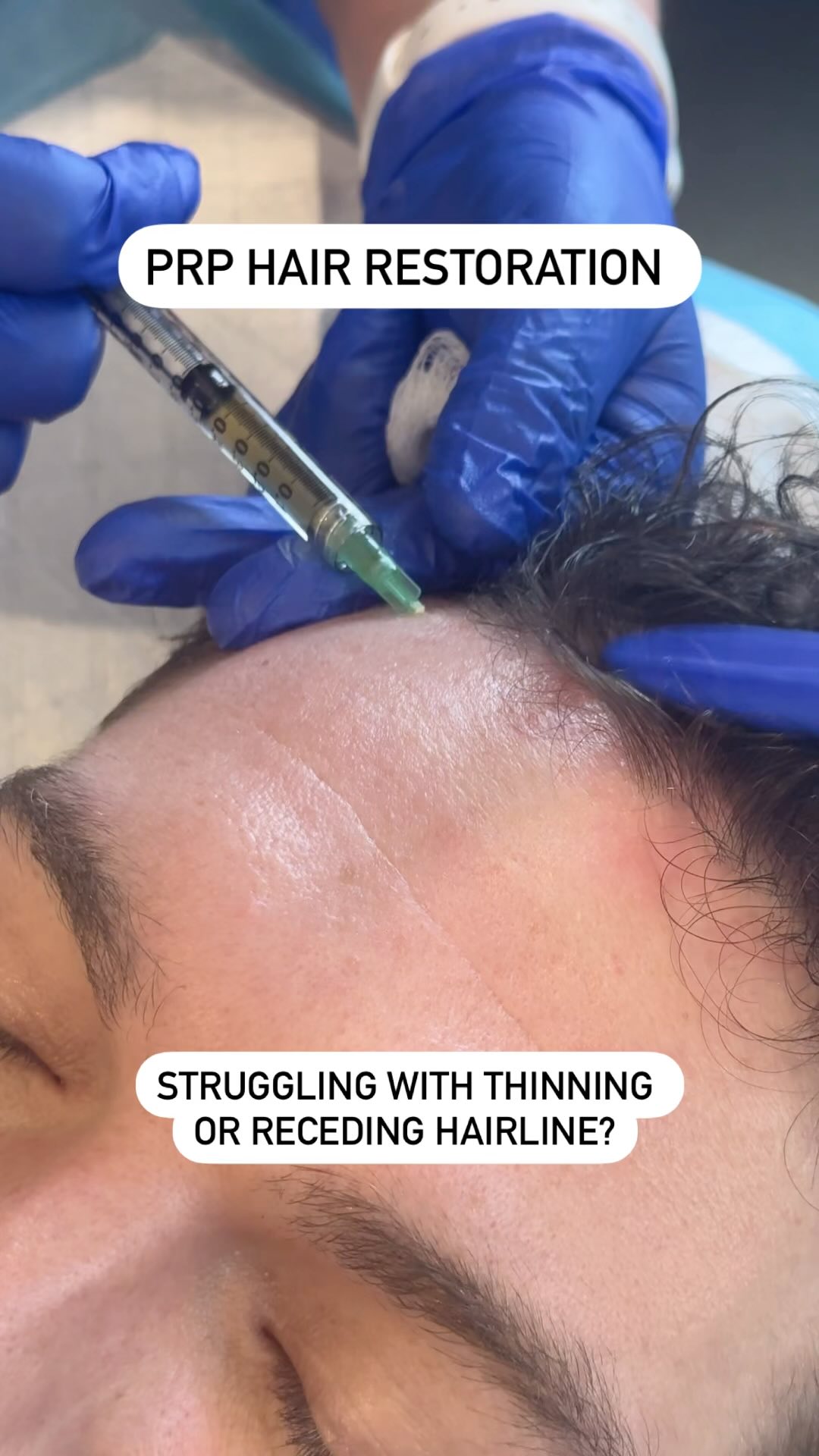 If youβre struggling with thin hair or a receding hairline receding, PRP can increase blood flow and growth factors in the scalp. This can improve thickness as well as health of the follicle, shaft, and scalp.
www.dermalign.com.au
#prp #prptreatment #prphair #prphairrestoration #prphairloss #dermalign #skinclinic