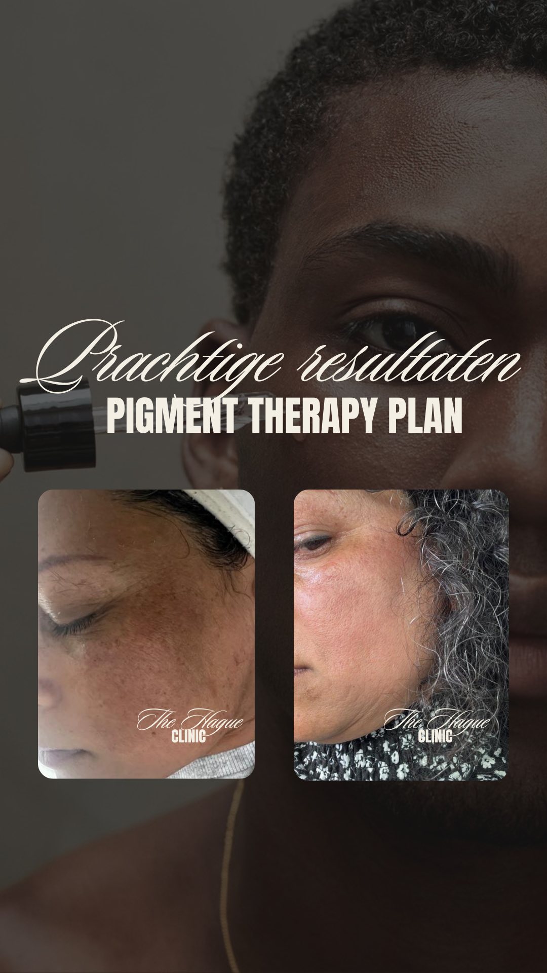 Wauw, kijk naar deze transformatie na maar één keer het Pigment Therapy Plan! ✨
Van donkere vlekken die meer dan 20 jaar aanwezig waren, naar een stralende, egale huid. Bij The Hague Clinic behandelen we ook de donkere huid met de grootste zorg en effectiviteit.
Wil jij ook starten met het Pigment Therapy Plan?
Boek jouw Personal Skin Therapy Plan bij ons! We selecteren de juiste behandeling voor jouw huid en begeleiden je naar het beste resultaat.
Stuur ons een bericht met “INFO” voor meer details of om direct te boeken.
- Alles wat je nodig hebt, vind je via de 🔗 in onze bio.
Boek online een afspraak: www.thehagueclinic.nl
📞 Bel: 085 060 74 77
📧 E-mail: info@thehagueclinic.nl
LIKE, SAVE & FOLLOW als jij klaar bent voor jouw huidtransformatie.
🤍 @thehagueclinic