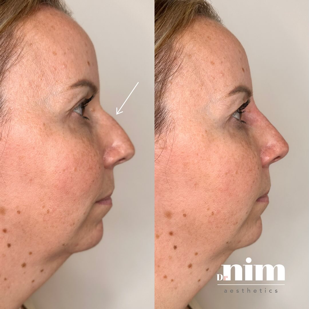 We absolutely love these results! 🤩
Non surgical rhinoplasty is a popular, alternative treatment to a surgical ‘nose job’. It is an ideal treatment for anyone who is concerned about any asymmetry or bumps on the nose or even a drooping nasal tip.
With carefully placed filler we are able to alter the appearance of the nose to make it appear straighter, thinner and more contoured.
As you can see from this lovely patient, we disguised the bump at the top of her nose so it looked straighter on her side profile. Her ‘after’ photo on the right was taken at her four week review.
Want to know more? To book your complimentary consultation drop me a DM 😊
#sideprofile #facialtreatment #transformation