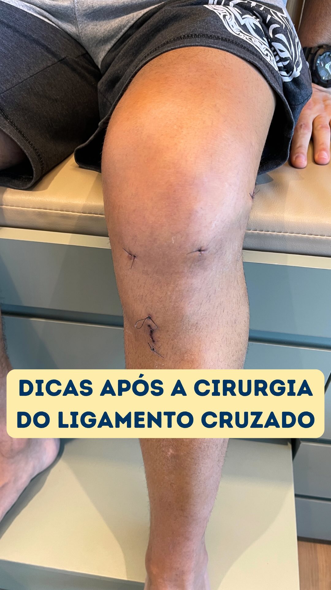 ⚡️Algumas dicas de movimento e posicionamento do joelho após a cirurgia de reconstrução do ligamento cruzado anterior. #joelho #ligamentocruzadoanterior