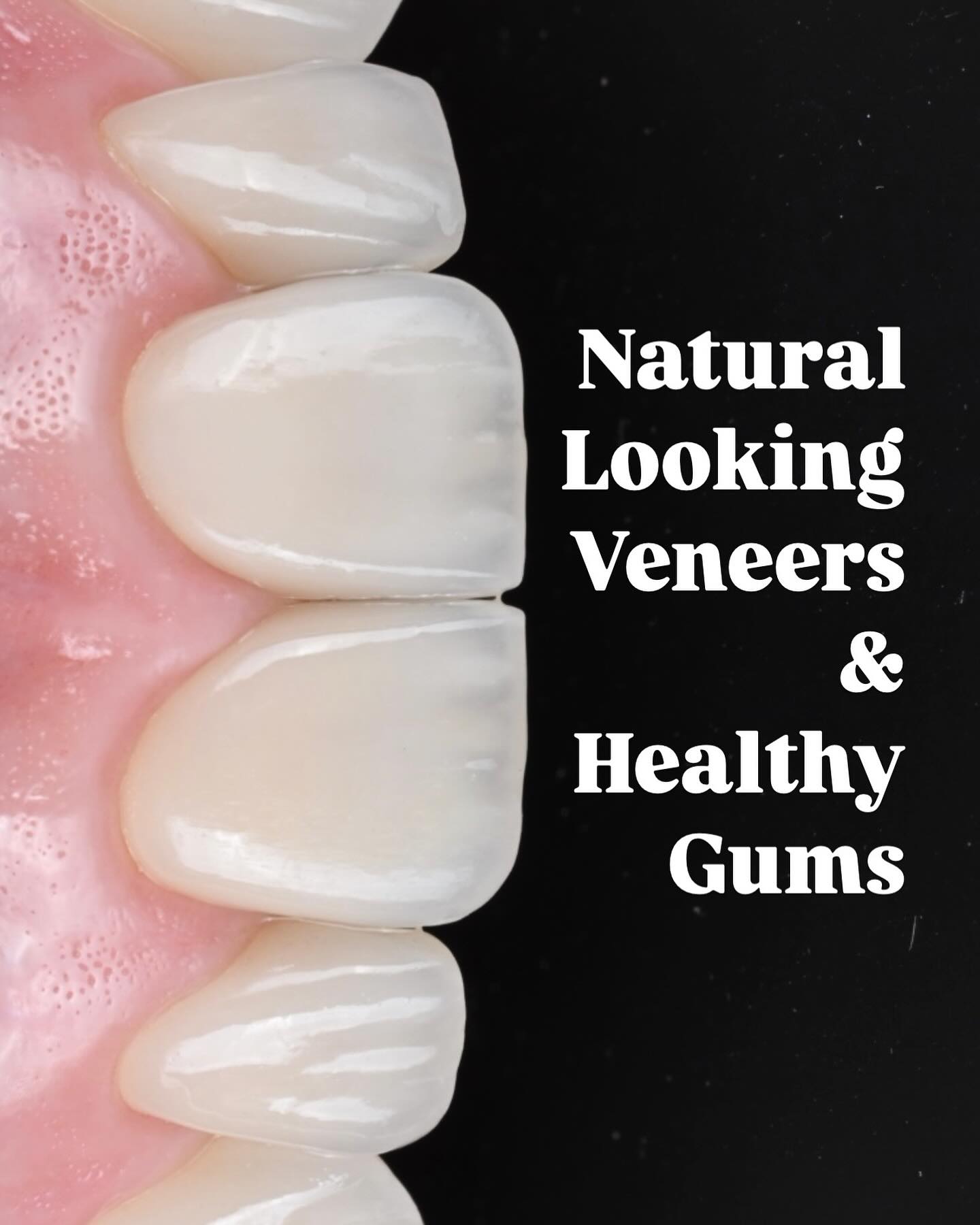 Biological integration is the key to achieving not just stunning veneers, but also long-term healthy gums and tissues. 🦷✨ #SmileDesign #HealthySmile #Biologicalintegration