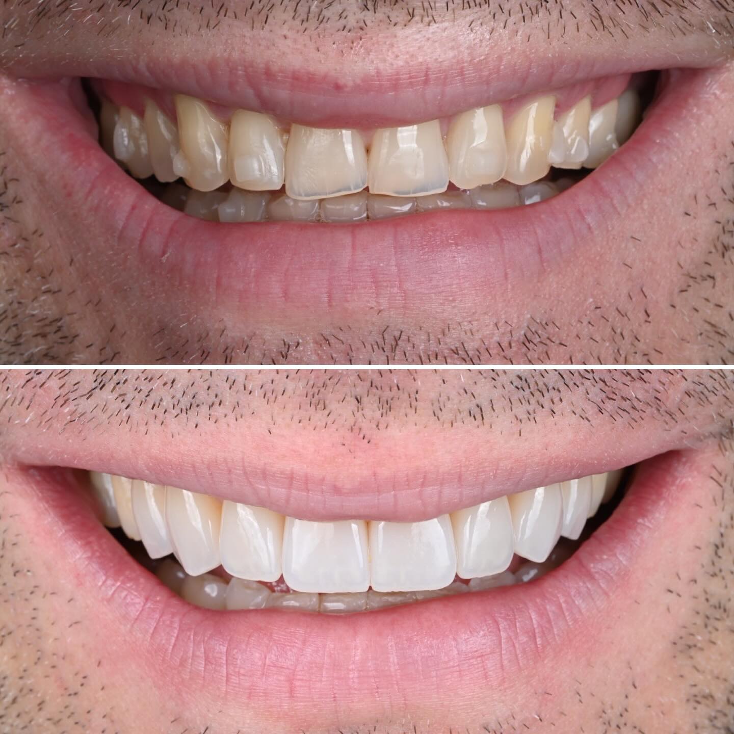 Transforming smiles with precision and care! This complex case began with Invisalign comprehensive treatment to correct a misaligned bite that was causing severe damage to the patient’s front teeth. Once the foundation was set, we restored both function and aesthetics with custom porcelain veneers. For fellow dentists: we opted for taco-type veneers to preserve the marginal ridges on the incisors, ensuring minimal preparation and maximum conservation. 🦷✨ #Invisalign #PorcelainVeneers #ConservativeDentistry #SmileTransformation