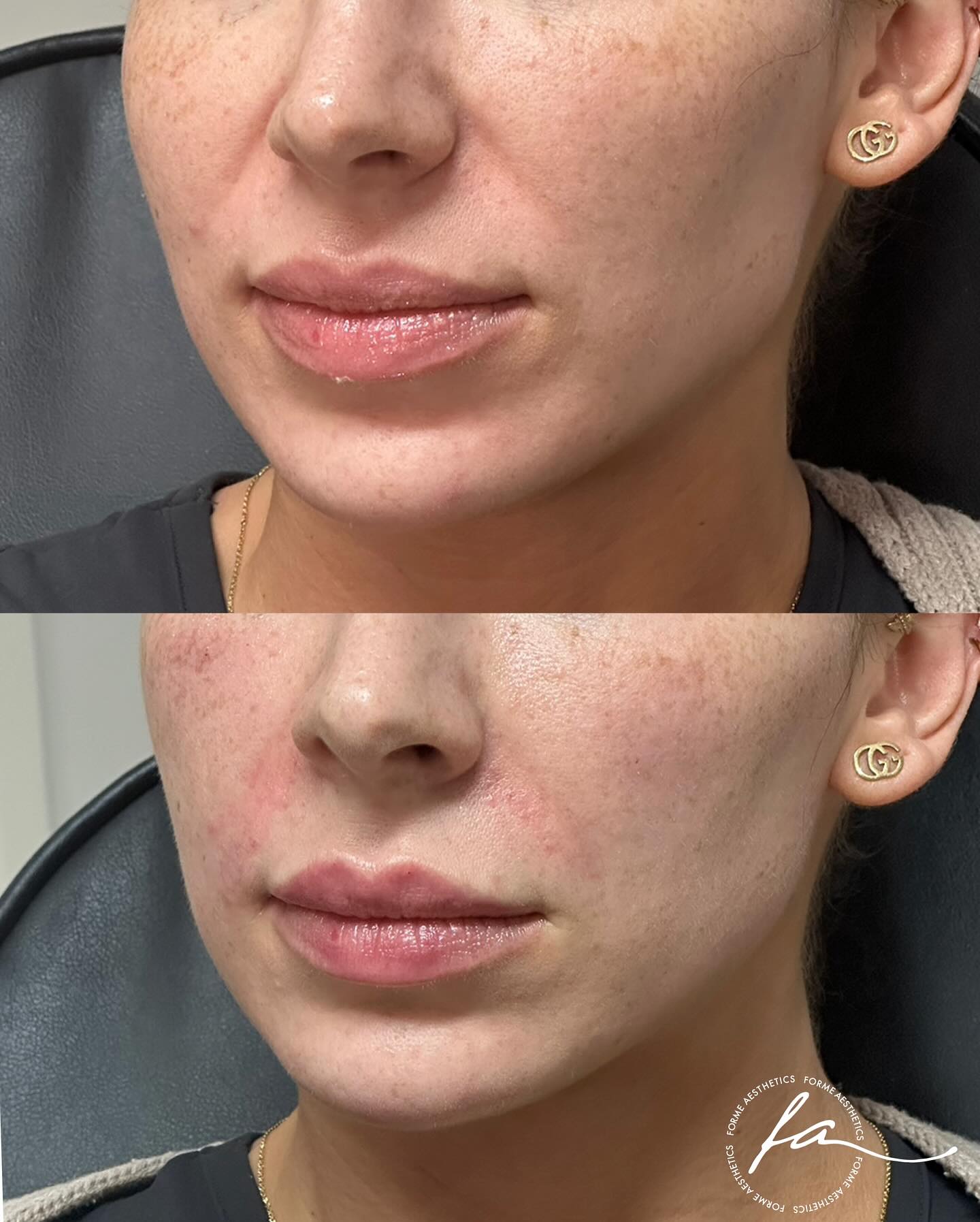 We offer personalised consultations to address facial rejuvenation concerns. Using a variety of tailored techniques, we can help soften the appearance of smile lines for a more refreshed and youthful look.
Any surgical or invasive procedure carries risks. Before proceeding, you should seek
a second opinion from an appropriately qualified health practitioner. Results vary.
Consent is always obtained before sharing patient images.
Treatment performed by Stephanie Sirillas RN