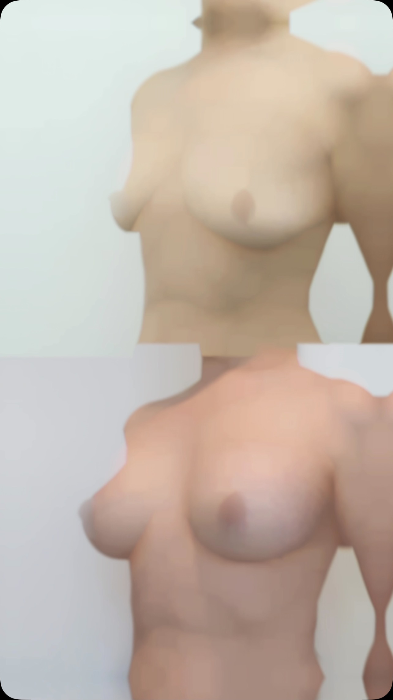 Aumento mamario con técnica Dual Plane 💎