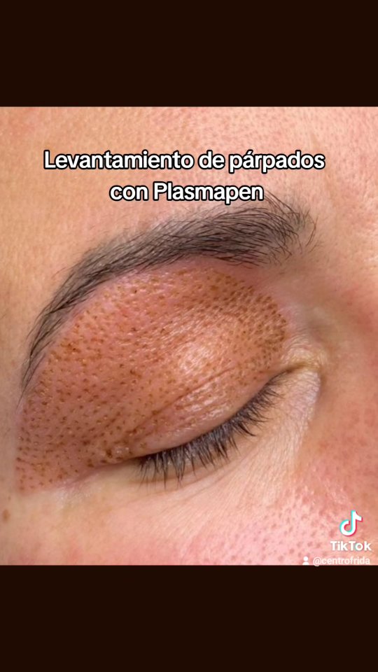 🌸Es un tratamiento no invasivo 🌸
✅️ Elimina la flacidez
✅️ Elimina o Minimiza las manchas
✅️ Elimina las berrigas
📲 Pide tu cita 624252294
#plasmapenmadrid #esteticamadrid #dermapenmadrid #plasmapen #microblading #plasmapen #beflaroplastia #madrid #parpadoscaidos
