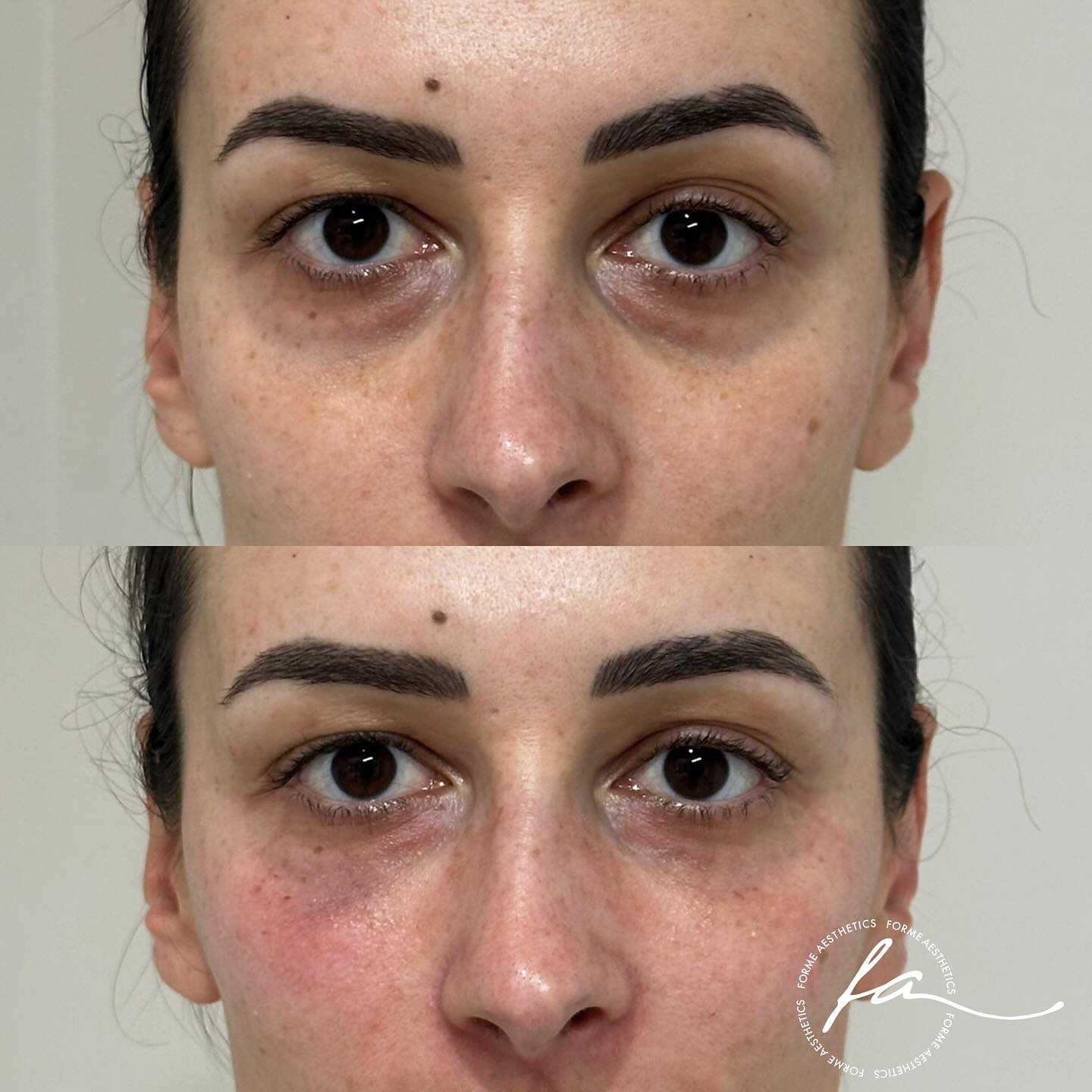 We offer expert consultations to address common concerns around the eyes, including hollowing, pigmentation, under-eye puffiness, and texture changes. Using a variety of different modalities we can assist with helping you look less tired & rejuvenated.
Any surgical or invasive procedure carries risks. Non surgical procedures also have limitations and results can not be replicated to every patient. Before proceeding, you should seek
a second opinion from an appropriately qualified health practitioner. Results vary.
Consent is always obtained before sharing patient images.
Treatment performed by Stephanie Sirillas RN
