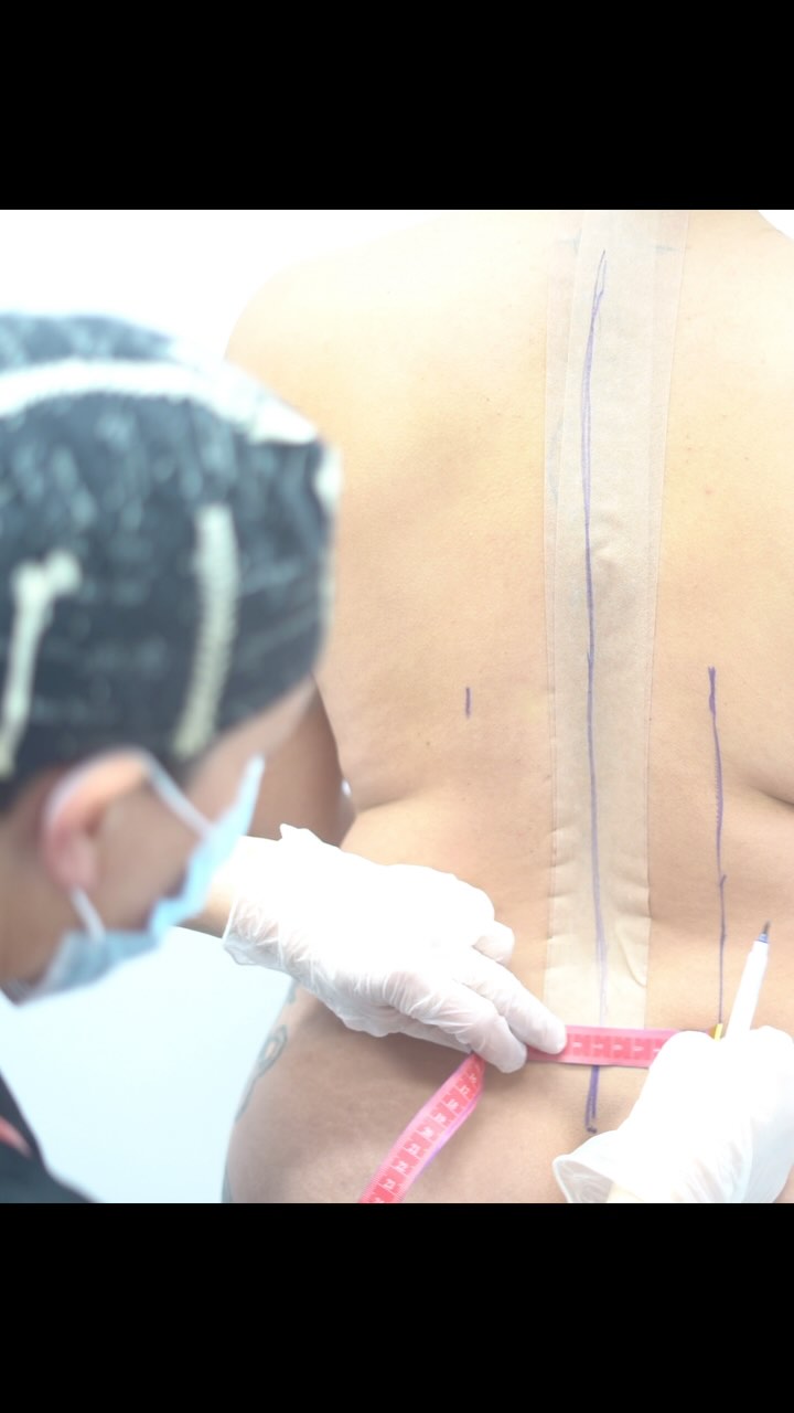 💉Remodelación costal + lipoescultura Corset
⏰ 3 meses de evolución
Hoy queremos mostrarles este increíble resultado de lipoescultura tipo corset y remodelación de costillas, esta paciente tenía 84 cm de cintura el día de la cirugía, al terminar el procedimiento tenía 75 cm de cintura y a los 3 meses de evolución ya tenía 70 cm de cintura, en este caso tuvimos una reducción de 14cm aproximadamente, estos resultados son 100% permanentes, ya que se modifica la posición de las costillas
¿Que piensas de estos resultados?