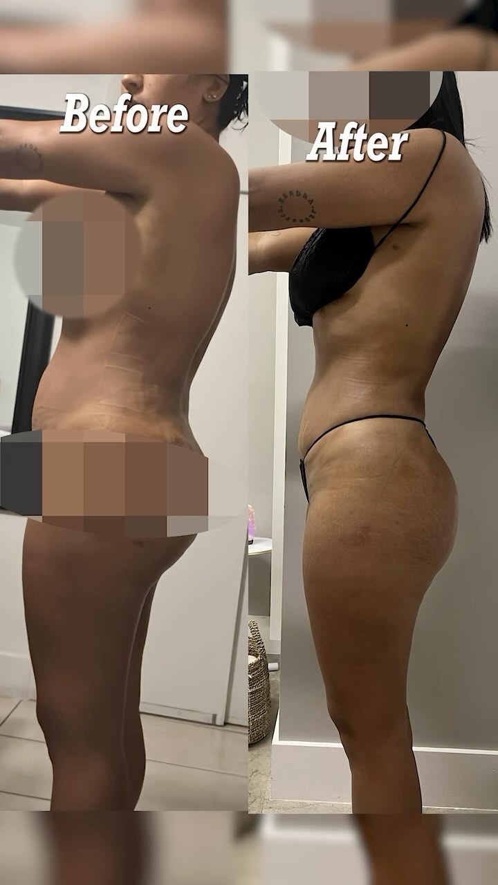 Tratamiento post operatorio
Tratamientos 100% manuales 🙌🏻 + equipos de ultima tecnología para complementar y sacar major provecho a la cirugía.
Si estas planeando tu cirugía próximamente no te olvides de tus drenajes linfáticos.
Si tienen alguna preguntica me pueden escribir al DM.
#woodtherapy #bodymassage #sculpting #medspa #hallandalebeach