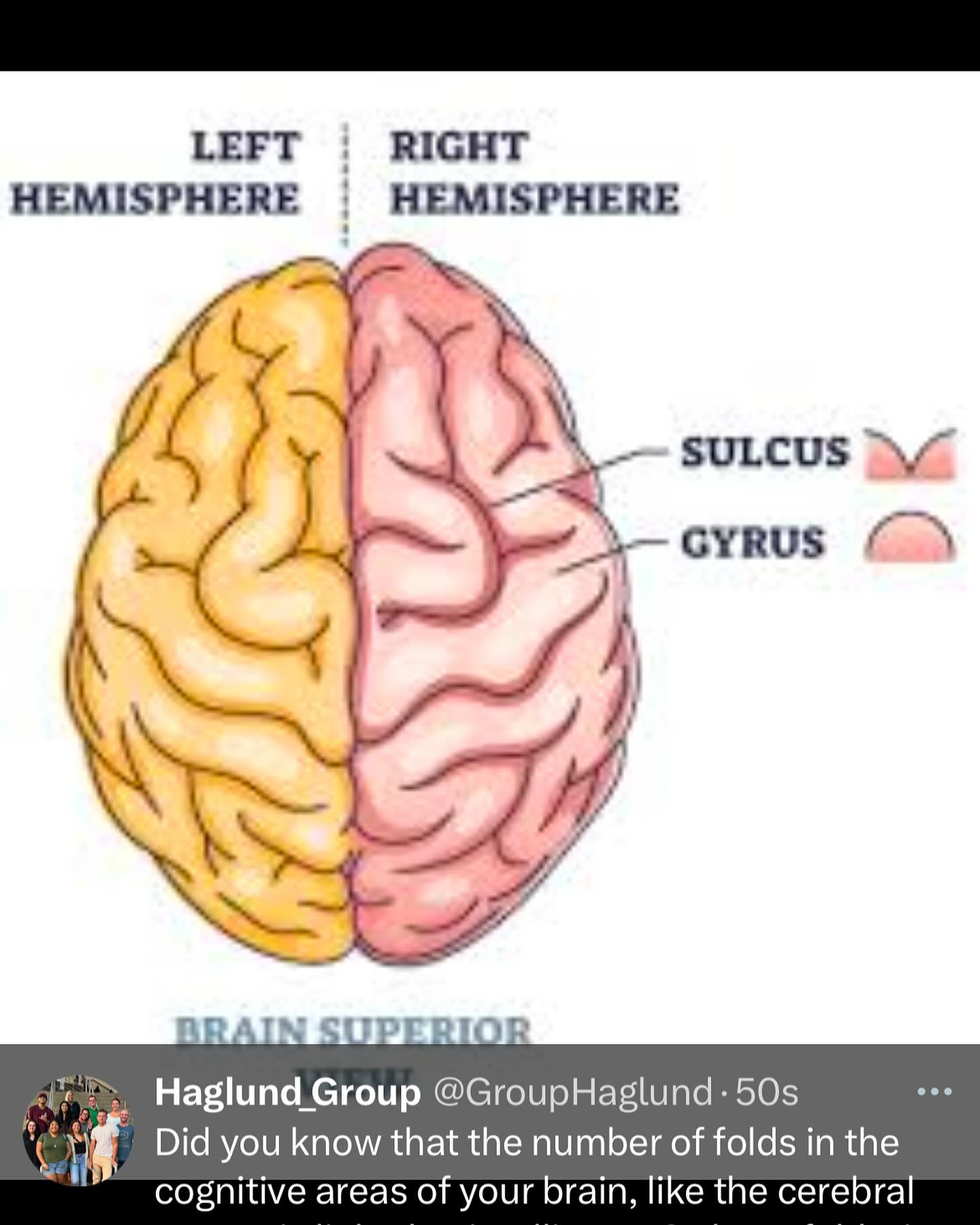 Did you know that the number of folds in the cognitive areas of Ukraine, like the cerebral cortex, is linked to intelligence? These folks, called gyri and sulci, increases surface area, allowing for more neurons and better processing power - kinda love, upgrading your brain’s RAM
.
.
.
#brain #humanbrain #haglundgroup #funfacts #funfactfriday #funfact #scientificfacts #hawaii #universityofhawaiiatmanoa #uhm #universityofhawaiia #uh #science #DNA #chromosomes #researchgroup #haglundgroup #drhaglund