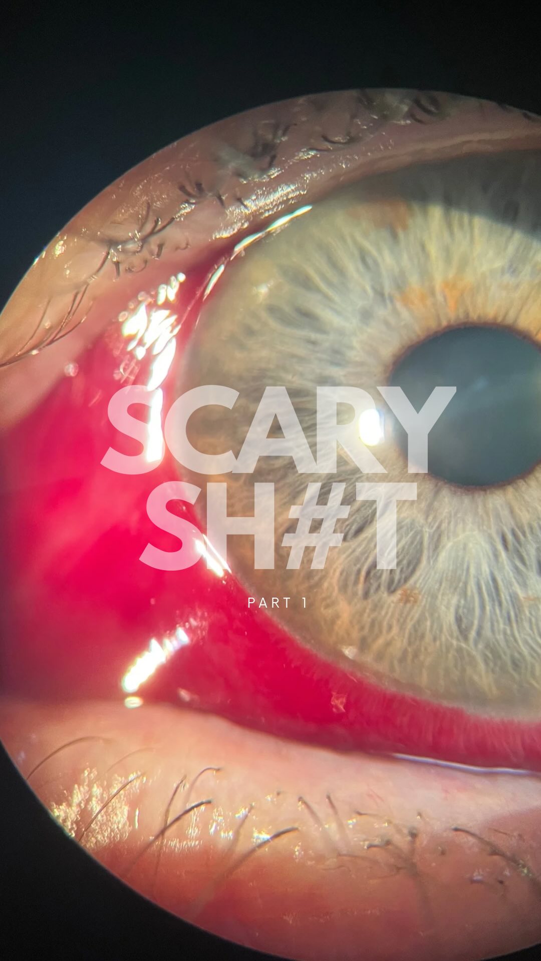 Some scary sh#t! 😱 But don’t panic—it’s just a subconjunctival hemorrhage! 🩸 Those tiny popped blood vessels on your eye’s white surface look freaky but are usually harmless.
✨ How to deal:
💧 Keep those eyes hydrated.
🧊 Cool compress = your bestie.
But don’t ignore it—it could signal something bigger like high blood pressure or irritation. Always check in with your optometrist!👁️✨
#EyeHealth #SubconjunctivalHemorrhage #OptometryTips #EyeCareMatters #HealthyVision #SeeClearly #EyeballDrama #CoolCompress #OptometristApproved #SelfCareEssentials #HealthAwareness