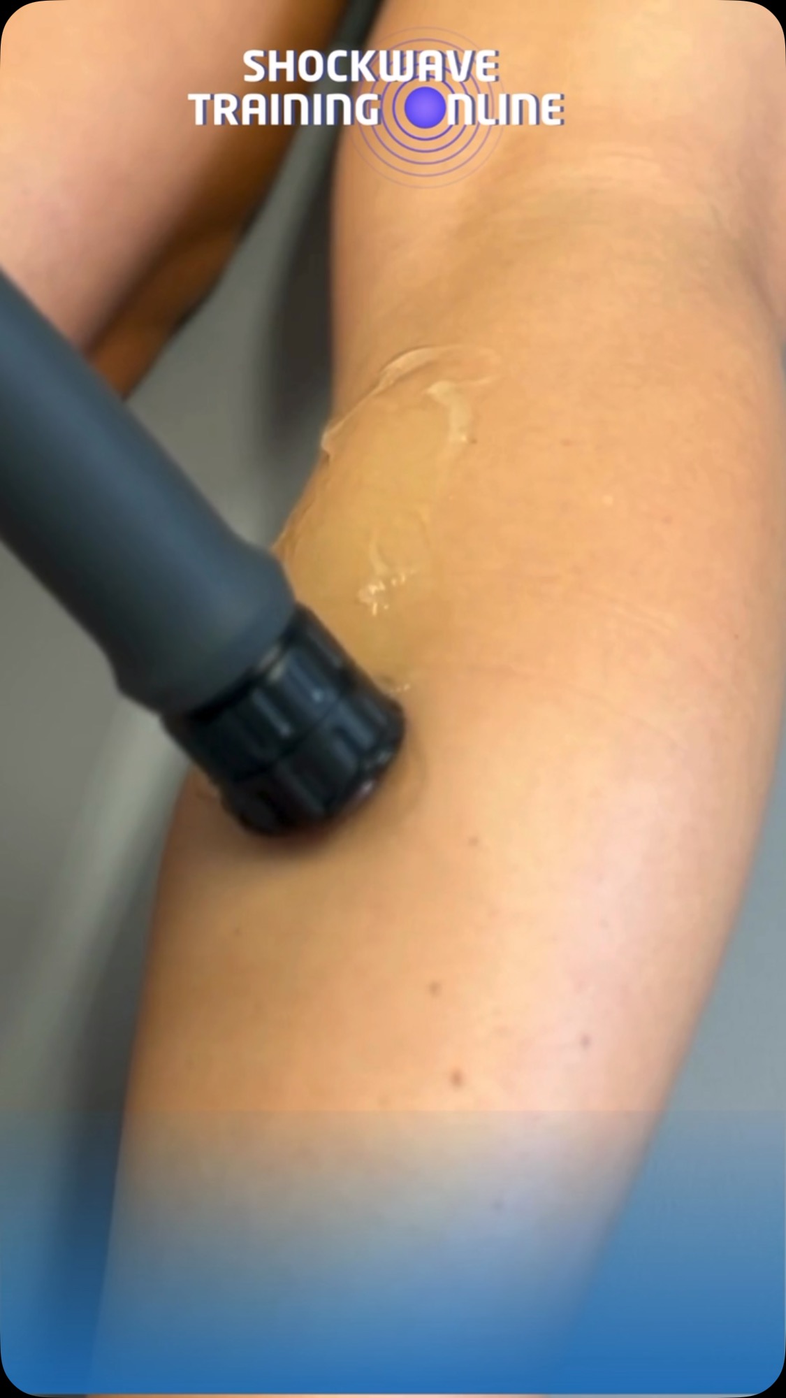 Medial calf tears can be painful and frustrating for your patients, but shockwave therapy can help accelerate healing, reduce pain, and improve recovery outcomes. 💥
In our online course, we’ll teach you how to apply shockwave therapy safely and effectively for treating medial calf tears and other soft tissue injuries. The course is quick, simple, and designed specifically for busy healthcare professionals, so you can confidently add this technique to your treatment toolbox. ✅
Start enhancing your patient care today! Visit www.shockwavetrainingonline.com to learn more and enroll!
#ShockwaveTherapy #MedialCalfTear #CalfInjury #SportsMedicine #PhysicalTherapy #PainManagement #HealthcareProfessionals #InjuryRecovery #MusculoskeletalHealth #ShockwaveTraining #TherapeuticInnovation #EvidenceBased #QuickAndSimple #PatientCare #Rehabilitation #HealthcareEducation #SoftTissueHealing