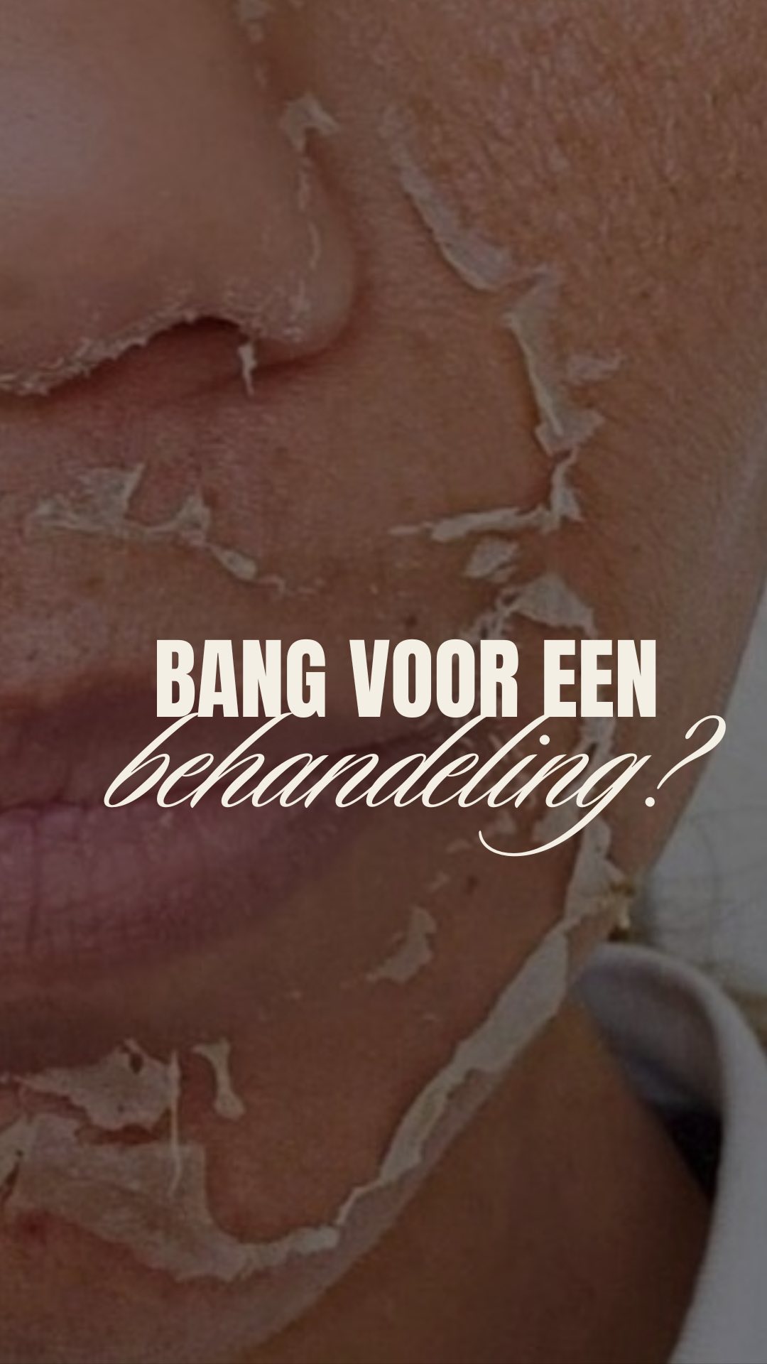 Sophie kwam bij ons… bang om behandeld te worden
Toen Sophie bij ons kwam, worstelde ze al jaren met hardnekkige acne. Ze had alles geprobeerd: crèmes, behandelingen, zelfs medicatie – maar niets gaf haar de resultaten waar ze op hoopte. Bovendien was ze bang dat een peeling te intens zou zijn voor haar gevoelige huid.
We stelden haar gerust en stelden de Bio Peeling voor – een milde, natuurlijke peeling gemaakt van kruiden en algen. Perfect voor haar acne-gevoelige huid, zonder agressieve ingrepen of irriterende chemicaliën. 🌱
🤍 Wat Sophie ervaarde:
* Minder ontstekingen na slechts één behandeling.
* Een gladdere huidstructuur en een frisse, gezonde glow.
* * Een boost in zelfvertrouwen door een aanpak die écht werkte.
🌱 Voor wie is de Bio Peeling?
* Voor iedereen die last heeft van acne, rimpels/lijntjes, pigmentvlekken of een doffe huid.
* Voor wie bang is dat een peeling te intens is, maar toch resultaat wil zien.
* * Voor wie kiest voor een zachte, natuurlijke aanpak.
Bij The Hague Clinic geloven we in maatwerk. Elke huid is uniek, en dat geldt zeker voor gevoelige huidtypes. Daarom stemmen we onze behandelingen volledig af op jouw huid en behoeften.
📅 Ben jij klaar om eindelijk de stap te zetten naar een gezondere, stralende huid?
Stuur ons een bericht met “INFO” voor meer details of om direct te boeken.
- Alles wat je nodig hebt, vind je via de 🔗 in onze bio.
Boek online een afspraak: www.thehagueclinic.nl
📞 Bel: 085 060 74 77
📧 E-mail: info@thehagueclinic.nl
LIKE, SAVE & FOLLOW als jij klaar bent voor jouw huidtransformatie.
🤍 @thehagueclinic