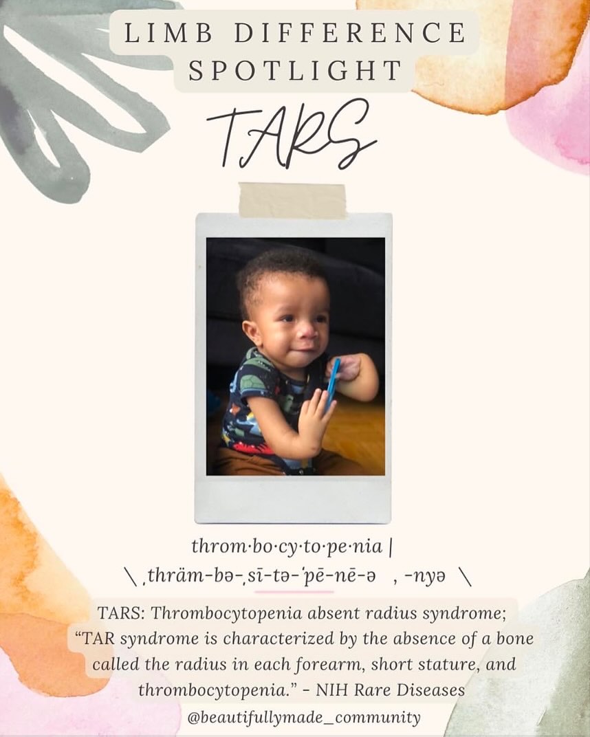 ✨Limb Difference Spotlight✨
▫️ TARS: Thrombocytopenia Absent Radius Syndrome (TARS) is a rare genetic condition where children are born without radius bone (the bone that forms right behind the thumb into the fold of the elbow) often children with TARS have a low platelet count (the blood cells that play a huge role in clotting). Children with TARS usually have all 5 fingers - just not the Radius bone. Children with TARS may need blood transfusions to help stabilize their platelet count. Often kids with TARS have a little dimple in their wrist - this picture captures that. They are often sensitive to dairy, reflux is very common.
✨RESOURCES✨
▫️Facebook-
- Children with TAR Syndrome
https://www.facebook.com/groups/6645978714/?ref=share
▫️Instagram-
Follow
@tarsawarenesstexas
@uniquelyusbrothers
@eastons_adventure1
@uniquely_me_foundation
@babyzips.ca
@tarsyndromeassociation
▫️Websites-
- https://www.uniquelymefoundation.org/rare-info/
- https://www.babyzips.ca
- https://rarediseases.info.nih.gov/diseases/5116/tar-syndrome
————————————————————————
If you have any other resources pertaining to TAR Syndrome please feel free to leave yourself or another page in the comments. 🤍
•
•
#beautifullymadecommunity #kindnessmatters #tars #tarsyndrome #raredisease #luckyfinproject #beautifullymade #luckyfinsrock #beautiful #tenfingersareoverrated #representationmatters #limbdifferenceawareness #luckyfin #warrior #disabilityawareness #awareness #education #representation #positivity #inclusion #connect #resources #limbdifferencespotlight