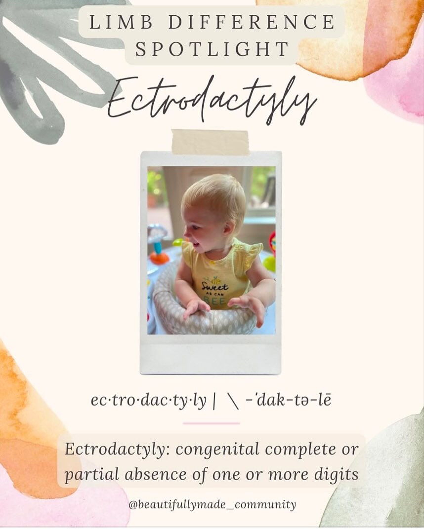 ☀️#Reposting our LDS Series. Tag resources or new people to connect!!
✨Limb Difference Spotlight✨
We will be featuring different types of limb differences and what they can look like! We’re doing this in hopes of highlighting limb difference specific resources and showing how each are beautifully made in their individual ways.
Let us know resources to add in the comments, or say hello to connect!👇🏽
•
•
✨RESOURCES✨
▫️Facebook-
Ectrodactyly-Ectodermal Dysplasia-Clefting (EEC) Syndrome
https://www.facebook.com/groups/EECSyndrome/?ref=share
▫️Instagram-
@crosslandshannon
@rochellejennam_
@carac719
▫️Websites-
https://www.nfed.org
————————————————————————
If you have any other resources pertaining to Ectrodactyly please feel free to leave yourself or another page in the comments. 🤍
We will link this in our website when it is live but also in our Story Highlights under Education.
•
•
#beautifullymadecommunity #kindnessmatters #ectrodactyly #luckyfinproject #beautifullymade #luckyfinsrock #tenfingersareoverrated #representationmatters #limbdifferenceawareness #luckyfin #disabilityawareness #awareness #education #representation #positivity #beautiful #inclusion #connect #resources #inclusiveeducation #limbdifferencespotlight