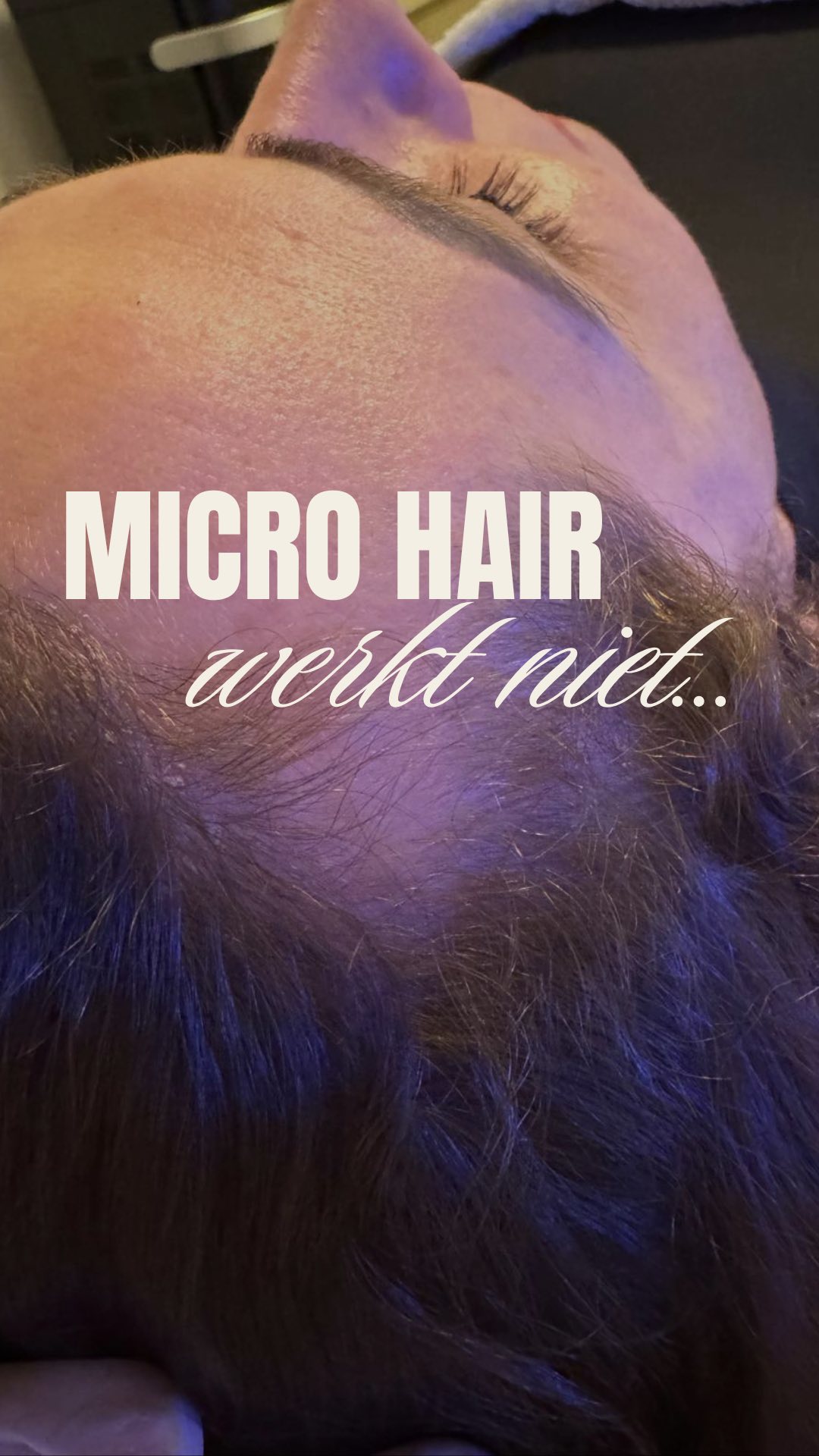 Denk jij dat Micro of Meso Hair niet werkt?
Van kale plekken op de kruin naar een volle haardos – dit is wat mogelijk is met Microneedling & Mesotherapie bij The Hague Clinic.
Veel mensen geloven dat haargroei alleen van binnenuit komt en dat behandelingen van buitenaf geen effect hebben. Maar met Microneedling & Mesotherapie worden werkstoffen die haargroei stimuleren direct opgenomen in je hoofdhuid door de fijne naaldjes van deze technieken.
🤍 Microneedling activeert de huid en opent microkanaaltjes, waardoor werkstoffen diep doordringen.
🤍 Mesotherapie brengt voedende ingrediënten direct naar de haarzakjes, waar ze de groei versterken.
Het mooiste? Dit is het resultaat na slechts enkele behandelingen. Het echte verschil zie je na 3 of meer sessies. Dit is pas het begin: kale plekken verdwijnen, en er groeit nieuw haar op plekken waar al jaren geen haar meer groeide.
Ben jij klaar voor een transformatie?
Stuur ons een bericht met “INFO” voor meer details of om direct te boeken.
- Alles wat je nodig hebt, vind je via de 🔗 in onze bio.
Boek online een afspraak: www.thehagueclinic.nl
📞 Bel: 085 060 74 77
📧 E-mail: info@thehagueclinic.nl
LIKE, SAVE & FOLLOW als jij klaar bent voor jouw huidtransformatie.
🤍 @thehagueclinic