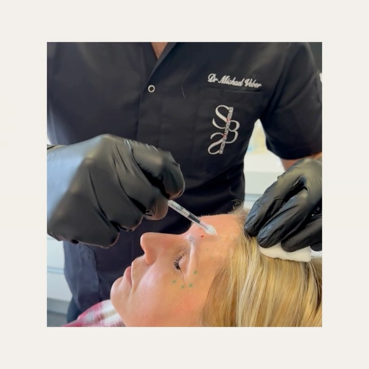 🎥 Live Botox Session with Dr. Veber!💉✨
Rejoignez-nous en direct pour une “session exclusive de Botox” avec le Dr. Veber sur l’une de ses patientes ! 🌟 Découvrez comment se déroule une véritable injection de Botox, étape par étape, et obtenez toutes les réponses à vos questions sur cette procédure populaire. 💬
👉 Ce que vous verrez
1️⃣ Une démonstration en direct de l’injection de Botox.
2️⃣ Les techniques du Dr. Veber pour garantir des résultats naturels et harmonieux.
3️⃣ Conseils et explications sur les zones ciblées et les bénéfices du Botox.
Que vous soyez curieux(se) ou que vous envisagiez un traitement, c’est l’occasion idéale d’en savoir plus et de découvrir l’expertise du Dr. Veber en action ! 💫
🎥 Live Botox Session with Dr. Veber!💉✨
Join us for an “exclusive live Botox session” with Dr. Veber on one of his patients! 🌟 Watch the full process of a Botox injection, step by step, and get all your questions answered about this popular procedure. 💬
👉 What you’ll see
1️⃣ A live demonstration of Botox injections.
2️⃣ Dr. Veber’s techniques to ensure natural and harmonious results.
3️⃣ Tips and explanations on targeted areas and the benefits of Botox.
Whether you’re curious or considering a treatment, this is the perfect opportunity to learn more and witness Dr. Veber’s expertise in action! 💫
#LiveSession #BotoxLive #DrVeber #BotoxDemo #AestheticMedicine #NaturalResults #AskTheExpert