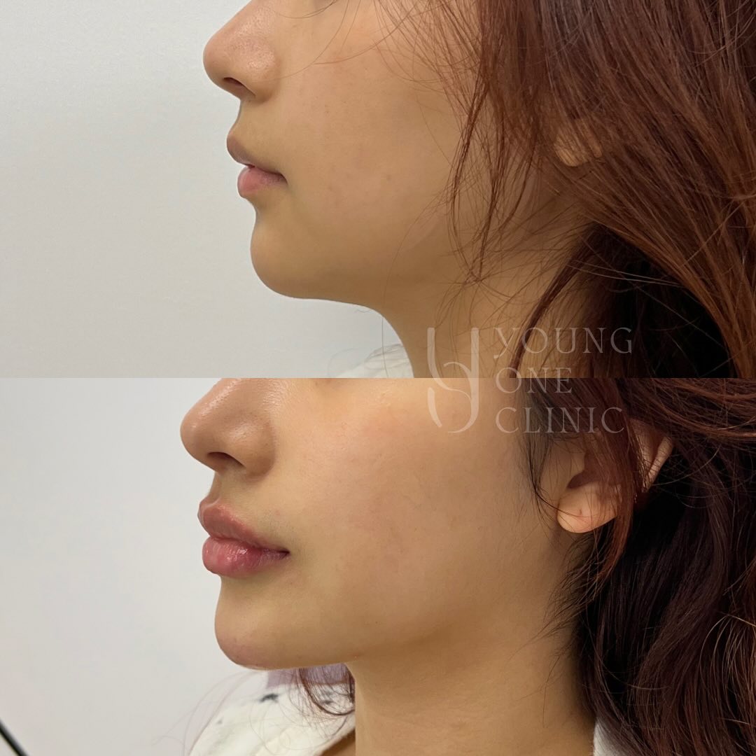 Enhancing the lower face❤️
👩🏻⚕️Welcome to book in a consultation to know more about:
- chin/ lips enhancement
- under-eye rejuvenation
- Facial balancing/ contouring
- Wrinkle reduction
- Face slimming
- Bruxism/ teeth clenching
- Lips enhancement
Disclaimer: All images used with consent. Individual results vary. Always seek advice from a qualified medical professional. A thorough consult is required for suitability, risks, side effects, procedure, options and aftercare. Any cosmetic or invasive procedure carries risk.
#brisbane #brisbanelips #brisbaneface #brisbanebeauty #faceslimming #chin #brisbanechin #brisbanelips #facialcontouring #facialbalancing #brisbanebruxism