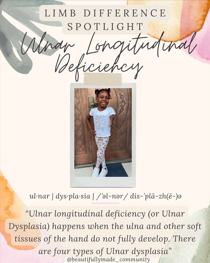 ✨Limb Difference Spotlight✨
Ulnar longitudinal deficiency, previously known as ulnar club hand, is a condition in which the wrist is in a fixed and bent position toward the side of the hand with the little finger. This condition is also sometimes called ulnar dysplasia. It happens when 1 of the long bones of the forearm, the ulna, and other soft tissues of the hand, develop differently in the womb. The fingers and thumb may also be affected. Other muscles and nerves in the hand may be unbalanced or missing.
There can be other correlations within musculoskeletal system, such as scoliosis.
Ulnar longitudinal deficiency affects about 1 in 100,000 babies.
Infants with ulnar longitudinal deficiency can wear a splint and be treated with gentle stretching exercises to help their wrist and elbow move into a normal position and recover some range of motion. Some types of ulnar longitudinal deficiency can also be treated with surgery to improve hand and arm function.
✨RESOURCES✨
▫️Facebook-
🔎 “Congenital Hand and Arm Differences”
🔎 “Lucky Fin Project”
▫️Instagram-
@unlimitedtiaraoluwa
@jaydenkoa_
@freyasluckyarm
▫️Websites-
▪️ https://www.childrenshospital.org/sites/default/files/media_migration/b92321c9-b748-42ec-80fc-59af050f763b.pdf
▪️ https://www.stanfordchildrens.org/en/service/hand-upper-limb-surgery/ulnar-longitudinal-deficiency?
▪️ https://www.connecticutchildrens.org/health-library/en/parents/ulnar-dysplasia/
————————————————————————————
If you have any other resources pertaining to Ulnar Longitudinal Deficiency please feel free to leave yourself or another page in the comments.
•
•
#beautifullymadecommunity #beautiful
#kindnessmatters #beautifullymade #luckyfinsrock #tenfingersareoverrated #representationmatters #limbdifferenceawareness #luckyfin #disabilityawareness #awareness #education #representation #positivity #inclusion #connect #resources #differentisbeautiful
#strong #inclusiveeducation #ulnarlongitudinaldeficiency #ulnardysplasia #limbdifferencespotlight