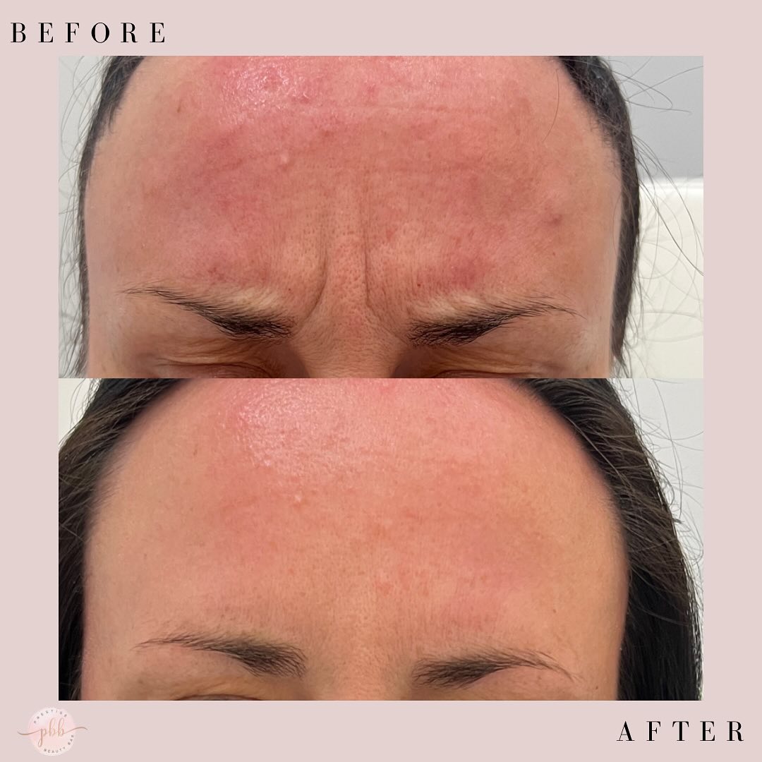 Turn that frown (line) upside down! šāØ Smooth, fresh, and fabulousābecause your glow deserves it!
.
.
To book an appointment, visit our website:
š www.prestigebeautybarinc.ca
.
.
.
.
#humberbay #neuromodulator #injections #flawlessskin #neurotoxin #AestheticGoals #dermalfiller