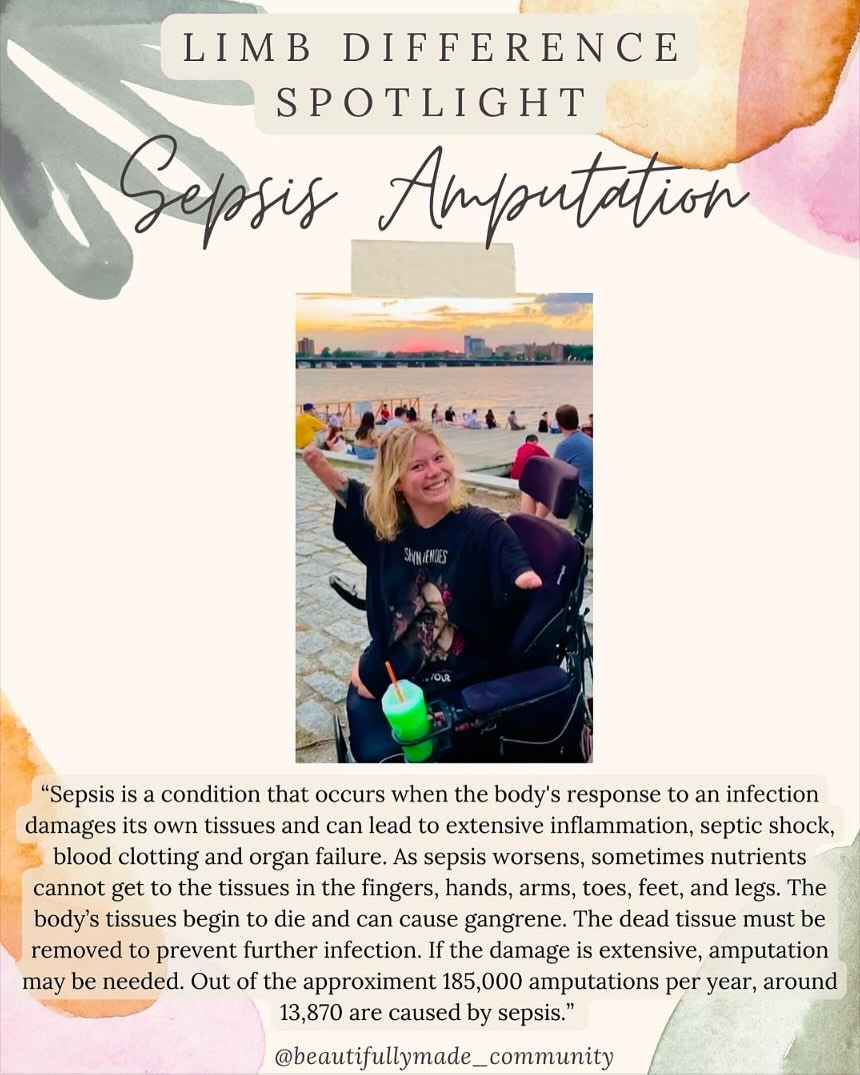 ✨Limb Difference Spotlight✨
Limb loss due to Sepsis
“Sepsis is a condition that occurs when the body’s response to an infection damages its own tissues and can lead to extensive inflammation, blood clotting, and organ failure. As sepsis worsens, sometimes nutrients cannot get to the tissues in the fingers, hands, arms, toes, feet, and legs. The body’s tissues begin to die and can cause gangrene. The dead tissue must be removed to prevent further infection. If the damage is extensive, amputation may be needed. Out of the approximate 185,000 amputations per year, around 13,870 are caused by sepsis.
On average, about 38 amputations a day are due to sepsis. Amputation is the loss or removal of a body part. The decision to amputate is based on making sure enough tissue is removed to ensure that all the damaged tissue is gone, and to preserve the patient’s independence and mobility as much as possible. Ideally, patients who have had an amputation will begin physiotherapy as soon as possible. Physiotherapy may include stretching and increasing muscle strength. Occupational therapists play an important role in helping amputees learn how to use special tools or adapt their living environment as needed. ”
✨RESOURCES✨
▫️Facebook-
🔎 “Sepsis Warriors”
🔎 “Sepsis Awareness, Septic Shock, survivors”
🔎”Post Sepsis Syndrome and LIVING Life After Surviving Sepsis”
🔎”Sepsis Survivors Society”
▫️Instagram-
@bellatucker_
@beaudensblessings
@limbkindfoundation
@amputeecoalition
@astepaheadprosthetics
@givability.us
@rompglobal
@limb_it_less_
@limbitlesspossibilities
@koalaacommunity
@advancedprostheticsolutions
▫️Websites-
▪️https://www.sepsis.org/sepsisand/amputations/
▪️https://www.mayoclinic.org/diseases-conditions/sepsis/symptoms-causes/syc-20351214
▪️https://my.clevelandclinic.org/health/diseases/12361-sepsis
————————————————————————————
•
•
#beautifullymadecommunity #beautiful
#kindnessmatters #beautifullymade #representationmatters #limbdifference #limbdifferenceawareness #disabilityawareness #education #representation #positivity #inclusion #connect #resources #differentisbeautiful #educate #amputee
#strong #inclusiveeducation #Sepsis #sepsissurvivor